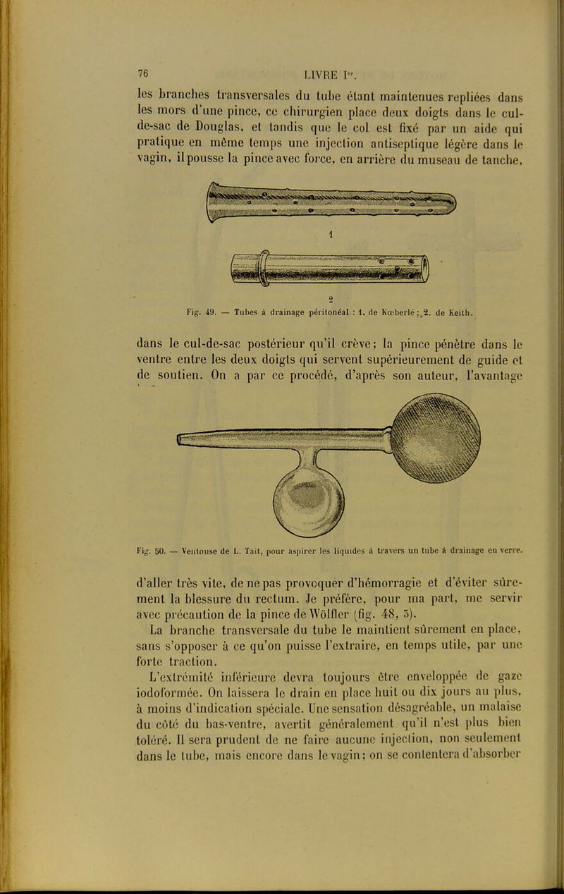 les branches transversales du tube étant maintenues repliées dans les mors d'une pince, ce chirurgien place deux doigts dans le cul- de -sac de Douglas, et tandis que le col est fixé par un aide qui pratique en même temps une injection antiseptique légère dans le vagin, il pousse la pince avec force, en arrière du museau de tanche. Fig. 49. — Tubes à drainage péritonéal : 1. de Kœberlé;.2. de Keitli. dans le cul-de-sac postérieur qu'il crève ; la pince pénètre dans le ventre entre les deux doigts qui servent supérieurement de guide et de soutien. On a par ce procédé, d'après son auteur, l'avantage Fig. 50. — Ventouse de L. Tait, pour aspirer les liquides à travers un tube à drainage en verre. d'aller très vite, de ne pas provoquer d'hémorragie et d'éviter sûre- ment la blessure du rectum. Je préfère, pour ma part, me servir avec précaution de la pince de Wôlfler (fig. 48, 5). La branche transversale du tube le maintient sûrement en place, sans s'opposer à ce qu'on puisse l'extraire, en temps utile, par une forte traction. L'extrémité inférieure devra toujours être enveloppée de gaze iodoformée. On laissera le drain en place huit ou dix jours au plus, à moins d'indication spéciale. Une sensation désagréable, un malaise du côté du bas-ventre, avertit généralement qu'il n'est plus bien toléré. Il sera prudent de ne faire aucune injection, non seulement dans le tube, mais encore dans le vagin; on se contentera d'absorber