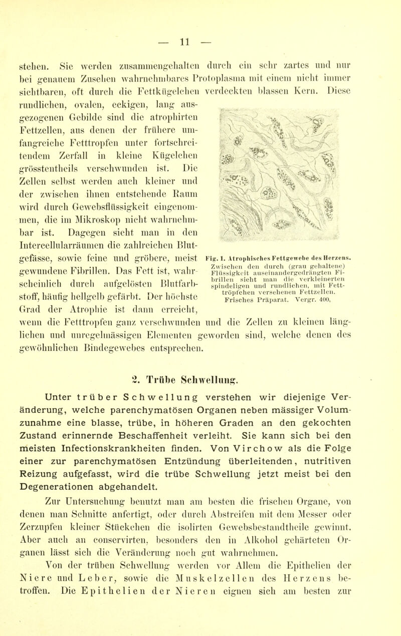 stehen. Sie werden zusammeng-ehalten durch ein sehr zartes und nur bei genauem Zusehen wahrnehmbares Protoplasma mit einem nicht inmier sichtbaren, oft durch die Fettküg-elclien verdeckten bhissen Kern. Diese rundlichen, ovalen, eckigen, lang aus- gezogenen Gebilde sind die atrophirten ... . Fettzellen, aus denen der frühere um- ^ v fangreiche Fetttropfen unter fortschrei- tendem Zerfall in kleine Kügelchen grösstentheils verschwunden ist. Die Zellen selbst werden auch kleiner und der zwischen ihnen entstehende Raum wird durch Gew^ebsflüssigkeit eingenom- men, die im Mikroskop nicht wahrnehm- bar ist. Dagegen sieht man in den Intercellularräumen die zahlreichen Blut- gefässe, sowie feine und gröbere, meist gewundene Fibrillen. Das Fett ist, wahr- scheinlich durch aufgelösten Blutfarb- stoff, häufig hellgelb gefärbt. Der höchste Grad der Atrophie ist dann erreicht, wenn die Fetttropfen ganz verschwunden und die Zellen zu kleinen läng- lichen und unregelmässigen Elementen geworden sind, welche denen des gewöhnlichen Bindegewebes entsprechen. Fig. 1. Atrophisches Fettgewebe des Her/eiis. Zwischen den durcli (grau gehaltene) Flüssigkeit auseinandergedrängten Fi- brillen sieht man die verkleinerten spindeligen und rundlichen, mit Fett- tröpfchen versehenen Fettzellen. Frisches Präparat. Vergr. 400, 2. Trübe Schwellung. Unter trüber Schwellung verstehen wir diejenige Ver- änderung, welche parenchymatösen Organen neben massiger Volum- zunahme eine blasse, trübe, in höheren Graden an den gekochten Zustand erinnernde Beschaffenheit verleiht. Sie kann sich bei den meisten Infectionskrankheiten finden. VonVirchow als die Folge einer zur parenchymatösen Entzündung überleitenden, nutritiven Reizung aufgefasst, wird die trübe Schwellung jetzt meist bei den Degenerationen abgehandelt. Zur Untersuchung benutzt man am besten die frischen Organe, von denen man Schnitte anfertigt, oder durch Abstreifen mit dem Messer oder Zerzupfen kleiner Stückchen die isolirten Gewebsbestandtheile gewinnt. Aber auch an conservirten, besonders den in Alkohol gehärteten Or- ganen lässt sich die Veränderung noch gut wahrnehmen. Von der trüben Schwellung werden vor Allein die Epithelien der Niere und Leber, sowie die M u s k e 1 z e 11 e n des Herzens be- troffen. Die Epithelien der Nieren eignen sich am besten zur