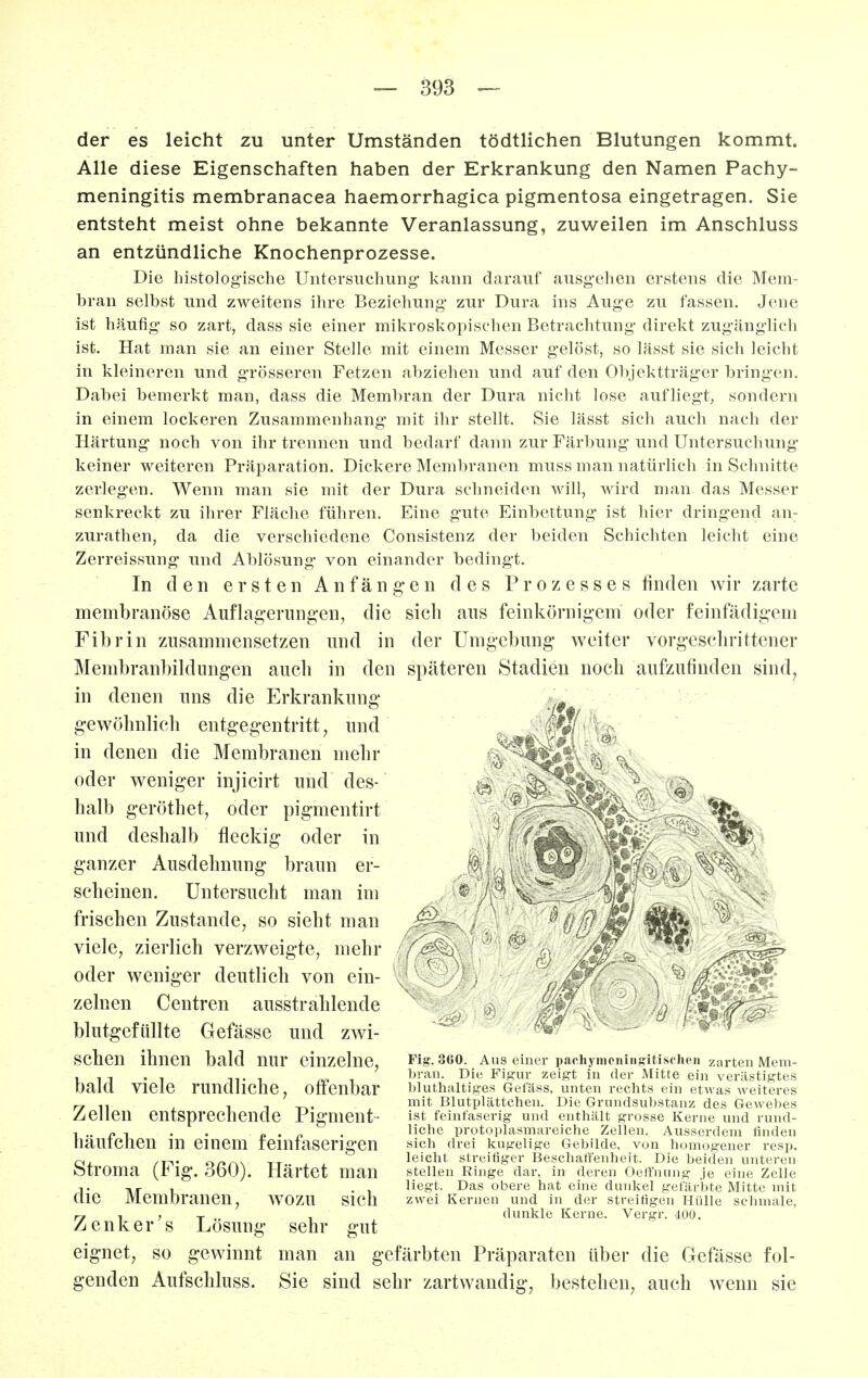 der es leicht zu unter Umständen tödtlichen Blutungen kommt. Alle diese Eigenschaften haben der Erkrankung den Namen Pachy- meningitis membranacea haemorrhagica pigmentosa eingetragen. Sie entsteht meist ohne bekannte Veranlassung, zuweilen im Anschluss an entzündliche Knochenprozesse. Die histologische Untersuchung' kann darauf ausgehen erstens die Mem- bran selbst und zweitens ihre Beziehung zur Dura ins Auge zu fassen. Jene ist häufig so zart, dass sie einer mikroskopischen Betrachtung direkt zugänglich ist. Hat man sie an einer Stelle mit einem Messer gelöst, so lässt sie sich leicht in kleineren und grösseren Fetzen abziehen und auf den Objektträger bringen. Dabei bemerkt man, dass die Membran der Dura nicht lose aufliegt, sondern in einem lockeren Zusammenhang mit ihr stellt. Sie lässt sich auch nach der Härtung noch von ihr trennen und bedarf dann zur Färbung und Untersuchung keiner weiteren Präparation. Dickere Membranen muss man natürlich in Schnitte zerlegen. Wenn man sie mit der Dura schneiden will, wird man das Messer senkreckt zu ihrer Fläche führen. Eine gute Einbettung ist hier dringend an- zurathen, da die verschiedene Consistenz der beiden Schichten leicht eine Zerreissung und Ablösung von einander bedingt. In den ersten Anfängen des Prozesses finden wir zarte membranöse Auflagerungen, die sich aus feinkörnigem oder feinfädigeni Fibrin zusammensetzen und in der Umgebung weiter vorgeschrittener Membranbildungen auch in den späteren Stadien noch aufzufinden sind, in denen uns die Erkrankung gewöhnlich entgegentritt, und in denen die Membranen mehr oder weniger injicirt und des- halb geröthet, oder pigmentirt und deshalb fleckig oder in ganzer Ausdehnung braun er- scheinen. Untersucht man im frischen Zustande, so sieht man viele, zierlich verzweigte, mehr oder weniger deutlich von ein- zelnen Centren ausstrahlende blutgefüllte Gefässe und zwi- schen ihnen bald nur einzelne, bald viele rundliche, offenbar Zellen entsprechende Pigment- häuf eben in einem feinfaserigen Stroma (Fig. 360). Härtet man die Membranen, wozu sich Zenker's Lösung sehr gut eignet, so gewinnt man an gefärbten Präparaten über die Gefässe fol- genden Aufschluss. Sie sind sehr zartwandig^ bestehen, auch wenn sie Fig. 300. Aus einer pachyiiicninffitischcn zarten Mem- bran. Die Fis'ur zeigt in der Mitte ein verästigtes bluthaltiges Gefäss, unten rechts ein etwas weiteres mit Blutplättchen. Die Grundsubstanz des Gewebes ist feinfaserig und enthält grosse Kerne und rund- liche protoplasmareiche Zellen. Ausserdem linden sich drei kugelige Gebilde, von homogener resp. leicht streitiger Beschaffenheit. Die beiden unteren stellen Ringe dar, in deren Oeffnung je eine Zelle liegt. Das obere hat eine dunkel gefärbte Mitte mit zwei Kernen und in der streitigen Hülle schmale, dunkle Kerne. Vergr. 400.
