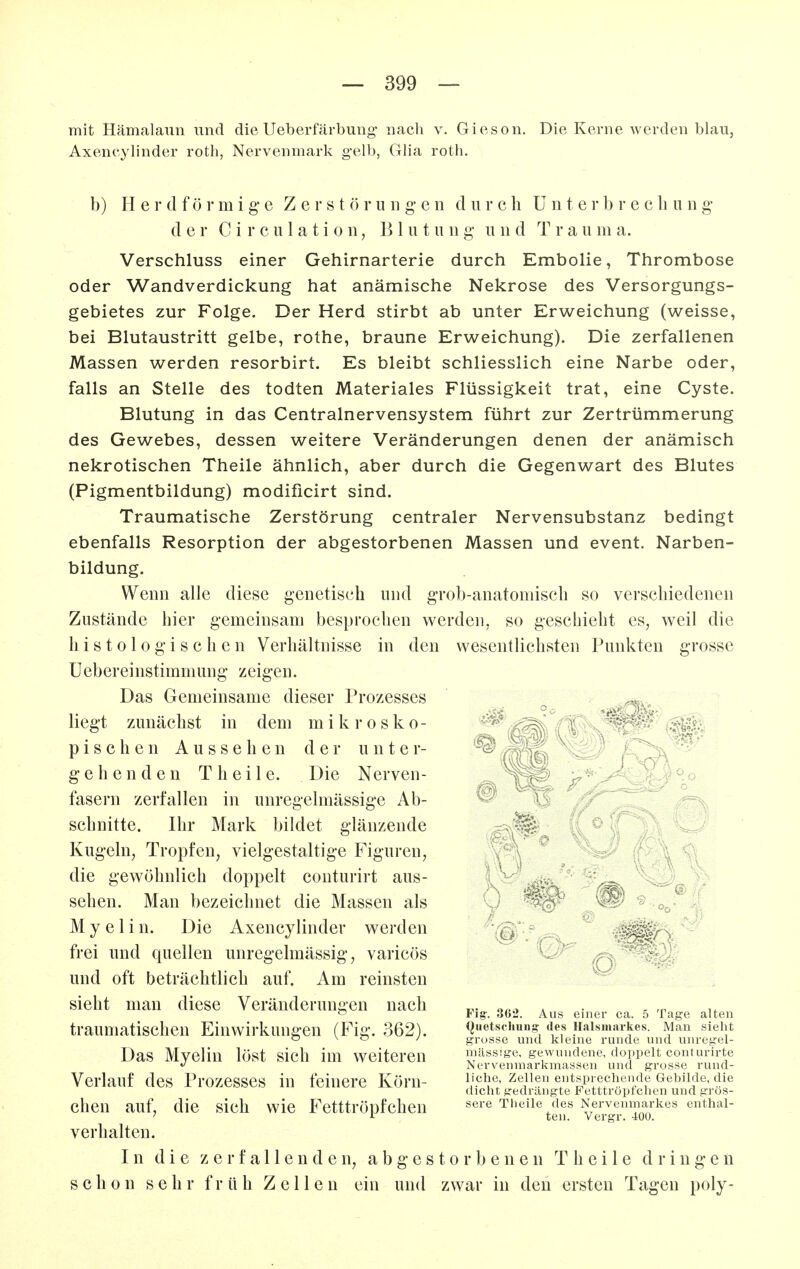 mit Hämalaun und die Ueberfärbung nach v. Gioson. Die Kerne werden blau, Axencylinder roth, Nervenmark g'elb, Glia roth. b) Herdförmige Z e r s t ö r u ii g- e n d u r c Ii ü n t e i- b r e c b u n g- der C i r c u 1 a t i 0 11, Blutung u n d T r a u m a. Verschluss einer Gehirnarterie durch Embolie, Thrombose oder Wandverdickung hat anämische Nekrose des Versorgungs- gebietes zur Folge. Der Herd stirbt ab unter Erweichung (weisse, bei Blutaustritt gelbe, rothe, braune Erweichung). Die zerfallenen Massen werden resorbirt. Es bleibt schliesslich eine Narbe oder, falls an Stelle des todten Materiales Flüssigkeit trat, eine Cyste. Blutung in das Centrainervensystem führt zur Zertrümmerung des Gewebes, dessen weitere Veränderungen denen der anämisch nekrotischen Theile ähnlich, aber durch die Gegenwart des Blutes (Pigmentbildung) modificirt sind. Traumatische Zerstörung centraler Nervensubstanz bedingt ebenfalls Resorption der abgestorbenen Massen und event. Narben- bildung. Wenn alle diese genetisch und grob-anatomiscb so verschiedenen Zustände hier gemeinsam besprochen werden, so geschieht es, weil die Ii i s 1010 g i s c h e n Verhältnisse in den wesentlichsten Punkten grosse Uebereinstimmung zeigen. Das Gemeinsame dieser Prozesses liegt zunächst in dem mikrosko- pischen Aussehen der unter- gehenden Theile. Die Nerven- fasern zerfallen in unregelmässige Ab- schnitte. Ihr Mark bildet glänzende Kugeln, Tropfen, vielgestaltige Figuren, die gewöhnlich doppelt conturirt aus- sehen. Man bezeichnet die Massen als Myelin. Die Axencylinder werden frei und quellen unregelmässig, varicös und oft beträchtlich auf. Am reinsten sieht man diese Veränderungen nach traumatischen Einwirkungen (Fig. 362). Das Myelin löst sich im weiteren Verlauf des Prozesses in feinere Körn- chen auf, die sich wie Fetttröpfchen verhalten. In die zerfallenden, abgestorbenen Theile dringen schon sehr früh Zellen ein und zwar in den ersten Tagen poly- Fig-. 362. Aus einer ca. 5 Tage alten (Juetscliung- des Halsmarkes. Man sieht gri)sse und kleine runde und unreyel- niässige, gewundene, doppelt conturirte Nervenmarkmassen und grosse rund- liche, Zellen entsprechende Gebilde, die dicht gedrängte Fetttröpfchen und grös- sere Tlieile des Nervenmarkes enthal- ten. Vergr. 400.