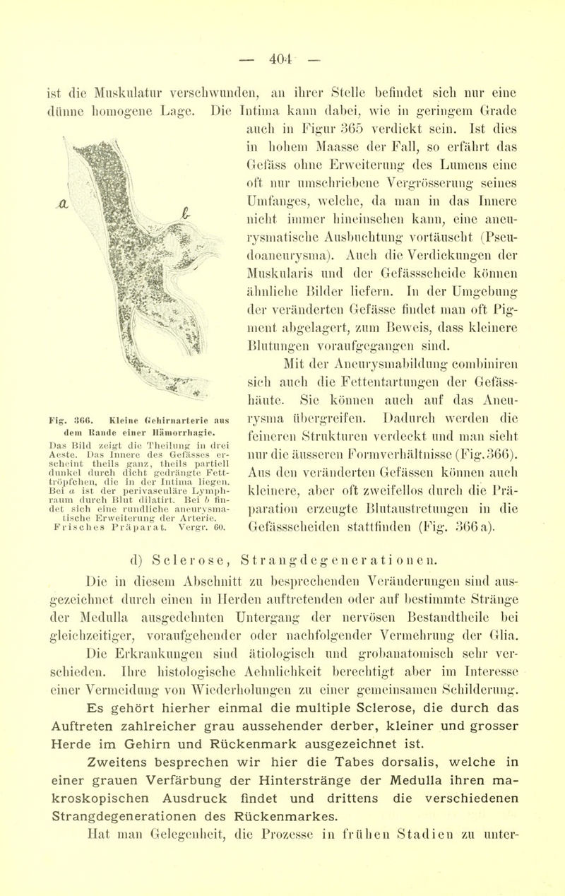 ist die Muskulatur verschwunden, an ihrer Stelle befindet sich nur eine dünne homogene Lage. Die Intima kann dabei, wie in geringem Grade auch in Figur 365 verdickt sein. Ist dies in hohem Maasse der Fall, so erfährt das Gefäss ohne Erweiterung des Lumens eine oft nur umschriebene VeroTösseruna- seines Ii Fig. 866. Kleine Oeliirnarterie aus dem Eaude einer Hänioriiiagie. Das Bild zeigt die Theilung' in drei Aeste. Das Innere des Gefässes er- scheint tlieils ganz, theils partieU dunkel durch dicht gedrängte Fett- tröpfehen, die in der Intima liegen. Bei a ist der perivasculäre Lymph- raum durch Blut dilatirt. Bei b fin- det sich eine rundliche aneurysma- tische Erweiterung der Arterie. Frisches Präparat. Vergr. 60. Umfanges, welche, da man in das Innere nicht immer hineinsehen kann, eine aneu- rysmatische Ausbuchtung vortäuscht (Pseu- doaneuiysma). Auch die Verdickungen der Muskularis und der Gefässscheide können ähnliche Bilder liefern. In der Umgebung der veränderten Gefässe findet man oft Pig- ment a])gelagert, zum Beweis, dass kleinere Blutungen voraufgegangen sind. Mit der Aneurysmabildung combiniren sich auch die Fettentartungen der Gefäss- häute. Sie können auch auf das Aneu- rysma übergreifen. Dadurch werden die feineren Strukturen verdeckt und man sieht nur die äusseren Formverhältnisse (Fig. 366). Aus den veränderten Gefässen können auch kleinere, aber oft zweifellos durch die Prä- paration erzeugte Blutaustretungen in die Gefässscheiden stattfinden (Fig. 366 a). d) S c 1 e r 0 s e , S t r a n g d e g e n e r a t i o n e n. Die in diesem Abschnitt zu besprechenden Veränderungen sind aus- gezeichnet durch einen in Herden auftretenden oder auf bestimmte Stränge der Medulla ausgedehnten Untergang der nervösen Bestandtheile bei gleichzeitiger, voraufgehender oder nachfolgender Vermehrung der Glia. Die Erkrankungen sind ätiologisch und groi)anatomisch sehr ver- schieden. Ihre histologische Aehnlichkeit berechtigt aber im Interesse einer Vermeidung von Wiederholungen zu einer gemeinsamen Schilderung. Es gehört hierher einmal die multiple Sclerose, die durch das Auftreten zahlreicher grau aussehender derber, kleiner und grosser Herde im Gehirn und Rückenmark ausgezeichnet ist. Zweitens besprechen wir hier die Tabes dorsalis, welche in einer grauen Verfärbung der Hinterstränge der Medulla ihren ma- kroskopischen Ausdruck findet und drittens die verschiedenen Strangdegenerationen des Rückenmarkes, Hat man Gelegenheit, die Prozesse in frühen Stadien zu unter-