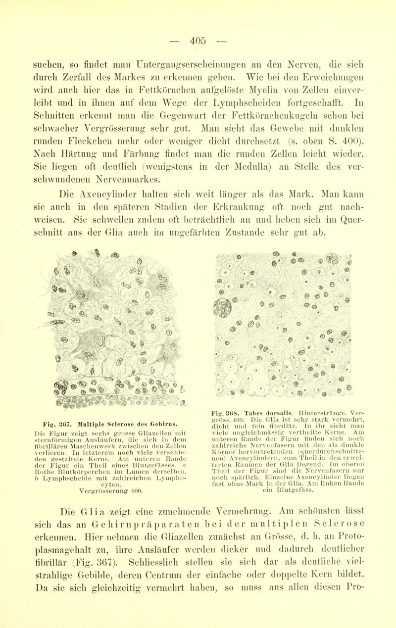 suchen, so findet man Untei'g'ang'sersclieinung-en an den Nerven, die sich durch Zerfall des Mai'kes zu erkennen geben. Wie bei den Erweichungen wird auch hier das in Fettkörnchen aufgelöste Myelin von Zellen einver- leibt und in ihnen auf dem Wege der Lymphscheiden fortgeschafft. In Schnitten erkennt man die Gegenwart der Fettkörnchenkugeln schon bei schwacher Yergrösserang sehr gut. Man sieht das Gewebe mit dunklen runden Fleckchen mehr oder weniger dicht durchsetzt (s. oben S. 400). Nach Härtung und Färbung findet man die runden Zellen leicht wieder. Sie liegen oft deutlich (wenigstens in der Medulla) an Stelle des ver- schvvundenen Nervenmarkes. Die Axencylinder halten sich weit länger als das Mark. Man kann sie auch in den späteren Stadien der Erkrankung oft noch gut nach- weisen. Sie schwellen zudem oft beträchtlich an und heben sich im Quer- schnitt aus der Glia auch in) ungefärbten Zustande sehr gut ab. SS # ,1?> V e & ^ ^^^^ Fig. 367. MuUiple Sclerose des Gehirns. Die Figur zeigt sechs grosse GliazeUeti mit sternförmigen Ausläufern, die sich in dem tibriUären Mascheuwerk zwischen den Zellen verlieren. In letzterem noch viele verschie- den gestaltete Kerne. Am unteren Rande der Figur ein Tlieil eines Blutgefässes, a Rothe Blutkörperchen im Lumen derselben. b Lymphscheide mit zahlreichen Lympho- cyten. Vergrös'serung ßOO. Fig. 368. Tabes dorsalis. Hinterstränge. Ver- gröss. 400. Die Glia ist sehr stark vermehrt, dicht und fein fibrillär. In ihr sieht man viele ungleichmässig vertheilte Kerne. Am unteren Rande der Figur finden sich noch zahlreiche Nervenfasern mit den als dunkle Körner hervortretenden (querdurchschnitte- nen) Axencylindern^ zum Theil in den erwei- terten Räumen der Glia liegend. Im oberen Theil der Figur sind die Nervenfasern }iur noch spärlich. Einzelne Axencylinder liegen fast ohne Mark in der Glia. Am' linken Rande ein Blutgefäss. Die Glia zeigt eine zunehmende Vermehrung. Am schönsten lässt sich das an G e h i r n p r ä p a r a t e n bei der multiplen Sclerose erkennen. Hier nehmen die Gliazellen zunächst an Grösse^ d. h. an Proto- plasmagehalt zu, ihre Ausläufer werden dicker und dadurch deutlicher fibrillär (Fig. 367). Schliesslich stellen sie sich dar als deutliche viel- strahlige Gebilde, deren Centrum der einfache oder doppelte Kern bildet. Da sie sich gleichzeitig- vermehrt haben, so muss aus allen diesen Pro-