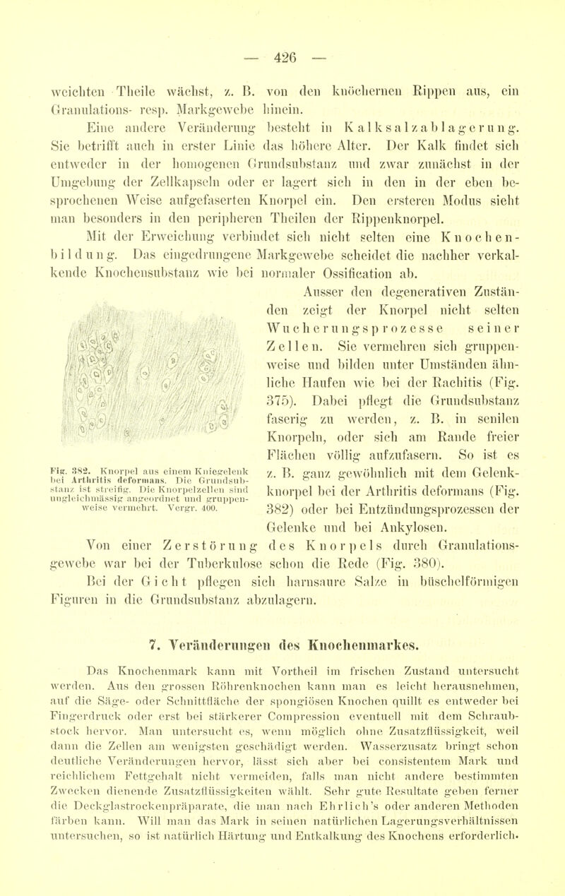 weichten Tlieile wächst, z. B. von den knöchernen Rippen aus, ein Granulations- resp. Markgewebe liinein. Eine andere Veränderung- ])esteht in K a 1 k s a 1 z a b 1 a g e r u n g. Sie betrifft auch in erster Linie das liöhere Alter. Der Kalk findet sich entweder in der homogenen Grundsubstanz und zwar zunächst in der Umgebung der Zellkapseln oder er lagert sich in den in der eben be- sprochenen Weise aufgefaserten Knorpel ein. Den ersteren Modus sieht man besonders in den peripheren Theilen der Rippenknorpel. Mit der Erweichung verbindet sich nicht selten eine Knochen- bild u n g. Das eingedrungene Markgewebe scheidet die nachher verkal- kende Knochensubstanz wie bei normaler Ossification ab. Ausser den degenerativen Zustän- den zeigt der Knoi-pel nicht selten W u c h e 1* u n g s p r 0 z e s s e seiner Zellen. Sie vermehren sich gruppen- weise und bilden unter Umständen ähn- liche Haufen wie bei der Rachitis (Fig. 375). Dabei pflegt die Grundsubstanz . ^ faseriff zu werden, z. B. in senilen Knorpeln, oder sich am Rande freier Flächen völlig aufzufasern. So ist es z. B. ganz gewöhnlich mit dem Gelenk- knorpel bei der Arthritis deformans (Fig. 382) oder bei Entztindungsprozessen der Gelenke und bei Ankylosen. Von einer Zerstörung des Knorpels durch Granulations- gewebe war bei der Tuberkulose schon die Rede (Fig. 380). Bei der Gicht pflegen sich harnsnure Salze in büschelförmigen Figuren in die Grundsubstanz abzula£>-ern. Fier. 382. Knorpel aus einem Knieg'elenk l)ei Arthritis deforiiiaiis. Die Gruiulsub- stanz ist streifig?. Die Knorpelzellen sind ungleiclimässif? anjreordnet und gruppen- weise vermehrt. Vergr. 400. 7. Yeränderuiigeii des Knoclieiimarkes. Das Knochenmark kann mit Vortheil im frischen Zustand untersuclit werden. Aus den o^rossen Röhrenknochen kann man es leicht herausnehmen, auf die Säge- oder Schnittfläche der spongiösen Knochen quillt es entweder hei Fingerdruck oder erst bei stärkerer Compression eventuell mit dem Schraub- stock hervor. Man untersucht es, wenn möglich ohne Zusatzflüssigkeit, weil dann die Zellen am wenigsten geschädigt werden. Wasserzusatz bringt schon deutliche Veränderungen hervor, lässt sich aber bei consistentem Mark und reichlichem Fettgehalt nicht vermeiden, falls man nicht andere bestimmten Zwecken dienende Zusatzflüssigkeiten wählt. Sehr gute Resultate geben ferner die Deckglastrockenpräparate, die man nach Ehrlich's oder anderen Methoden färben kann. Will man das Mark in seinen natüi'lichen Lagerungsverhältnissen untersuchen, so ist natürlich Härtung und Entkalkung des Knochens erforderlich.