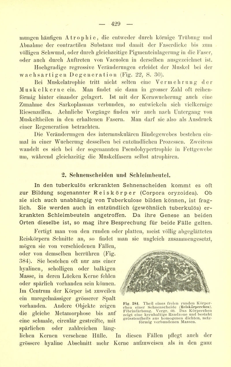 mungen häufig-en Atrophie, die entweder durch körnige Trühung* und Abnahme der eontraetilen Substanz und damit der Faserdicke bis zum völligen Schwund, oder durch gleichzeitige Pigmenteinlagerung in die Faser, oder auch durch Auftreten von Vacuolen in derselben ausgezeichnet ist. Hochgradige regressive Veränderungen erleidet der Muskel bei der wachsärtigen Degeneration (Fig. 22, S. 30). Bei Muskelatrophie tritt nicht selten eine Vermehrung der M u s k e 1 k e r n e ein. Man findet sie dann in grosser Zahl oft reihen- förmig hinter einander gelagert. Ist mit der Kernwucherung auch eine Zunahme des Sarkoplasmas verbunden, so entwickeln sich vielkernige Riesenzellen. Aehnliche Vorgänge finden wir auch nach Untergang von Muskeltheilen in den erhaltenen Fasern. Man darf sie also als Ausdruck einer Regeneration betrachten. Die Veränderungen des intermuskulären Bindegewebes bestehen ein- mal in einer Wucherung desselben bei entzündlichen Prozessen. Zweitens wandelt es sich bei der sogenannten Pseudohypertrophie in Fettgewebe um, während gleichzeitig die Muskelfasern selbst atrophiren. 2. Seliiiensclieiden und Sclileimbeutel. In den tuberkulös erkrankten Sehnenscheiden kommt es oft zur Bildung sogenannter Reiskörper (Corpora oryzoidea). Ob sie sich auch unabhängig von Tuberkulose bilden können, ist frag- lich. Sie werden auch in entzündlich (gewöhnlich tuberkulös) er- krankten Schleimbeuteln angetroffen. Da ihre Genese an beiden Orten dieselbe ist, so mag ihre Besprechung für beide Fälle gelten. Fertigt man von den runden oder platten, meist völlig abgeglätteten Reiskörpern Schnitte an, so findet man sie ungleich zusammengesetzt, mögen sie von verschiedenen Fällen, oder von demselben herrühren (Fig. 384). Sie bestehen oft nur aus einer hyalinen, scholligen oder balkigen Masse, in deren Lücken Kerne fehlen oder spärlich vorhanden sein können. Im Centrum der Körper ist zuweilen ein unregelmässiger grösserer Spalt vorhanden. Andere Objekte zeigen die gleiche Metamorphose bis auf eine schmale, circulär gestreifte, mit spärlichen oder zahlreichen läng- lichen Kernen versehene Hülle. In diesen Fällen pflegt auch der grössere hyaline Abschnitt mehr Kerne aufzuweisen als in den ganz Fig. 384. Theil eines freien runden Körper- chen einer Sehnenscheide (Reiskörpercheii). Fihrinf'ärbung. Vergr. GO. Das Körperchen zeigt eine kernhaltige Randzone und besteht grösstentheils aus liomogenen dichten, netz- förmig verbundenen Massen.