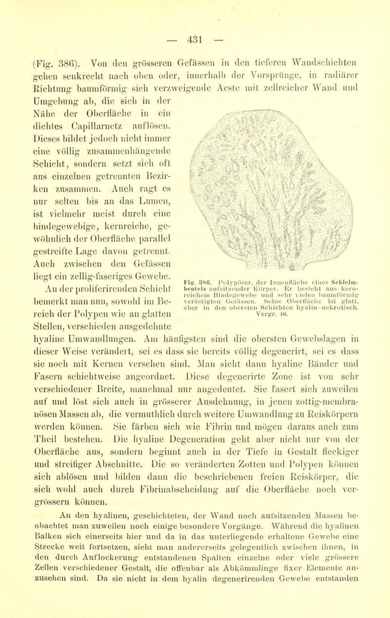 (Fig. 386). Von den grösseren Gefässen in den tieferen Wandschicliten geilen senl^reelit nacli ol)en oder^ innerlialb der Vorspränge, in radiärer Riclitnng baumförmig sich verzweigende Aeste mit zellreicber Wand und Umgebung ab, die sich in der Nälie der Oberfläche in ein dicbtes Capillarnetz auflösen. Dieses bildet jedoch nicht immer eine völlig zusammenhängende Schicht, sondern setzt sich oft aus einzelnen getrennten Bezir- ken zusammen. Auch ragt es nur selten bis an das Lumen, ist vielmehr meist durch eine bindegewebige, kernreiche, ge- wöhnlich der Oberfläche parallel gestreifte Lage davon getrennt. Auch zwischen den Gefässen liegt ein zellig-faseriges Gewebe. An der proliferirenden Schicht bemerkt man nun, sowohl im Be- reich der Polypen wde an glatten Stellen, verschieden ausgedehnte hyaline Umwandlungen. Am häufigsten sind die obersten Gewebslagen in dieser Weise verändert, sei es dass sie bereits völlig degenerirt, sei es dass sie noch mit Kernen versehen sind. Man sieht dann hyaline Bänder und Fasern schichtweise angeordnet. Diese degenerirte Zone ist von sehr verschiedener Breite, manchmal nur angedeutet. Sie fasert sich zuweilen auf und löst sich auch in grösserer Ausdehnung, in jenen zottig-membra- nösen Massen ab, die vermuthlich durch weitere Umwandlung zu Reiskörpern werden können. Sie färben sich wie Fibrin und mögen daraus auch zum Theil bestehen. Die hyaline Degeneration geht aber nicht nur von der Oberfläche aus, sondern beginnt auch in der Tiefe in Gestalt fleckiger und streifiger Abschnitte. Die so veränderten Zotten und Polypen können sich ablösen und bilden dann die beschriebenen freien Reiskörper, die sich wohl auch durch Fibrinabscheidung auf die Oberfläche noch ver- grössern können. An den hyalinen, geschichteten, der Wand noch aufsitzenden Massen be- obachtet man zuweilen noch einige besondere Vorgänge. Während die hj^alinen Balken sich einerseits hier und da in das unterliegende erhaltene Gewebe eine Strecke weit fortsetzen, sieht man andererseits gelegentlich zwischen ihnen, in den durch Auflockerung entstandenen Spalten einzelne oder viele grössere Zellen verschiedener Gestalt, die offenbar als Abkömmlinge fixer Elemente an- zusehen sind. Da sie nicht in dem hyalin degenerirenden Gewebe entstanden I 1 Fig. 386. Polypöser, der Innenfläche eines Sclileiin- Jieutels aufsitzender Körper. Er besteht aus kern- reichem Bindegewebe und sehr vielen baumfönnig- verästigten Gefässen. Seine Oberfläche ist glatt, aber in den obersten Schichten hyalin - nekrotisch. Vergr. 40.
