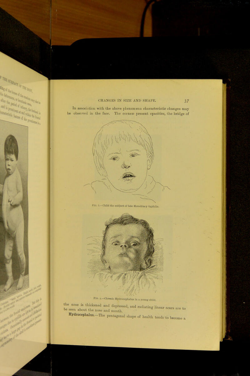 In association with the above phenomena characteristic changes may be observed in the face. The corneas present opacities, the bridge of 1, D'IS. 5—Child the subject of late Hereditary Syphilis. FIG. 7.-Chwmic Hydrocephalus in a young child. the nose is thickened and depressed, and radiating linear scars are to be seen about the nose and mouth HydrocephalUS.-The pentagonal shape of health tends to become a