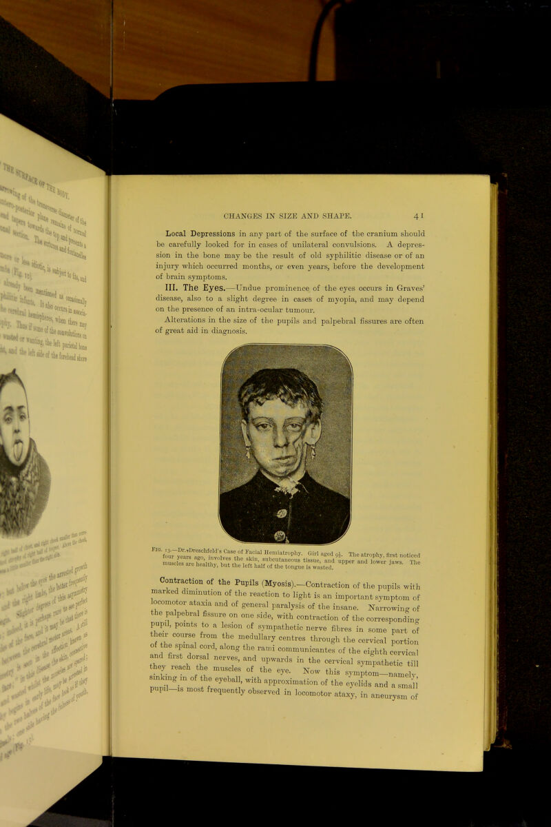 Local Depressions in any part of the surface of the cranium should be carefully looked for in cases of unilateral convulsions. A depres- sion in the bone may be the result of old syphilitic disease or of an injury which occurred months, or even years, before the development of brain symptoms. III. The Eyes.—Undue prominence of the eyes occurs in Graves' disease, also to a slight degree in cases of myopia, and may depend on the presence of an intra-ocular tumour. Alterations in the size of the pupils and palpebral fissures are often of great aid in diagnosis. ^^SSTS^SS^^ r,acial Hfn,i;atrophy-Girl !lsed * The ^ ^^Z^SVXT^^iupper and lower me Contraction of the Pupils (Myosis).-Contraction of the pupils with marked diminution of the reaction to light is an important symptom of ocomotor ataxia and of general paralysis of the insane. Narrowing of the palpebral fissure on one side, with contraction of the corresponding pupil, pomts to a lesion of sympathetic nerve fibres in some part 0^ thexr course from the medullary centres through the cervical portion of the spmal cord, along the rand communicantes of the eighth cervical and first dorsal nerves, and upwards in the cervical sympathetic till they reach the muscles of the eye. Now this symptom-namel smkrng m of the eyeball, with approximation of the eyelids and aTn ,' PUP11-18 most frequently observed in locomotor ataxy, in aneurysm