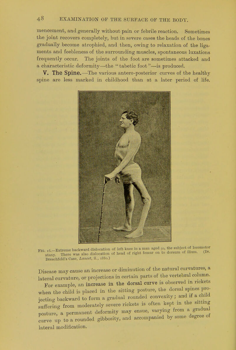 mencernent, and generally without pain or febrile reaction. Sometimes the joint recovers completely, but in severe cases the heads of the bones gradually become atrophied, and then, owing to relaxation of the liga- ments and feebleness of the surrounding muscles, spontaneous luxations frequently occur. The joints of the foot are sometimes attacked and a characteristic deformity—the  tabetic foot —is produced. V. The Spine.—The various antero-posterior curves of the healthy spine are less marked in childhood than at a later period of life. FIG i6.-Extreme backward dislocation of left knee in a man aged 50, the subject ataxy. There was also dislocation of head of right femur on to dorsum of Ilium. (Di. Dreschfeld's Case, Lancet, ii., 1880.) Disease may cause an increase or diminution of the natural curvatures, a lateral curvature, or projections in certain parts of the vertebral column. For example, an increase in the dorsal curve is observed m rickets when the child is placed in the sitting posture, the dorsal spines pro- iectins backward to form a gradual rounded convexity; and if a child suffering from moderately severe rickets is often kept in the sitting posture, a permanent deformity may ensue, varying from a gradual curve up to a rounded gibbosity, and accompanied by some degree of lateral modification.