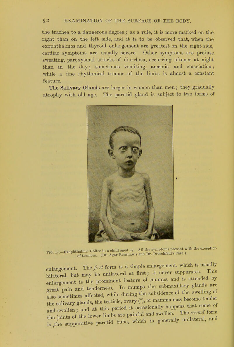 the trachea to a dangerous degree; as a rule, it is more marked on the right than on the left side, and it is to be observed that, when the exophthalmos and thyroid enlargement are greatest on the right side, cardiac symptoms are usually severe. Other symptoms are profuse sweating, paroxysmal attacks of diarrhoea, occurring oftener at night than in the day; sometimes vomiting, anaemia and emaciation; while a fine rhythmical tremor of the limbs is almost a constant feature. The Salivary Glands are larger in women than men; they gradually atrophy with old age. The parotid gland is subject to two forms of KIO 17 -Exophthalmic Goitre in a child aged 3J All the aymptomB present with the exception h IG. 17. V of tremors (Dr Agar Renshaw's and Dr. Dreschfeld s Case.) enlargement. The first form is a simple enlargement, which is usually bilateral, but may be unilateral at first; it never suppurates. Tins enlargement is the prominent feature of mumps, and is attended by !reat pain and tenderness. In mumps the submaxillary glands are Z solves affected, while during the subsidence of the swelling of tnTsalLry glands, the testicle, ovary (?), or mamma may become tende nd swollen,and at this period it occasionally^79^^ the ioints of the lower limbs are painful and swollen Ihe second lorm I^^ suppurative parotid bubo, which is generally unilateral, and