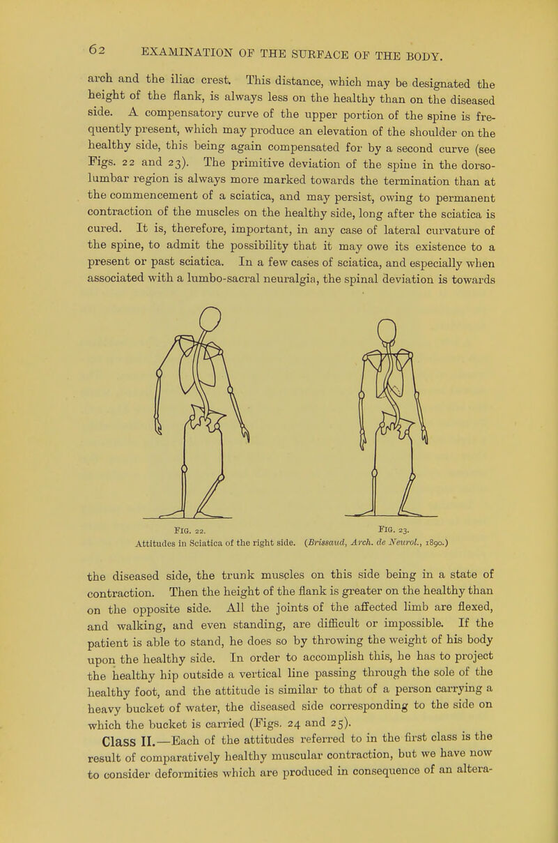 arch and the iliac crest. This distance, which may be designated the height of the flank, is always less on the healthy than on the diseased side. A compensatory curve of the upper portion of the spine is fre- quently present, which may produce an elevation of the shoulder on the healthy side, this being again compensated for by a second curve (see Figs. 22 and 23). The primitive deviation of the spiue in the dorso- lumbar region is always more marked towards the termination than at the commencement of a sciatica, and may persist, owing to permanent contraction of the muscles on the healthy side, long after the sciatica is cured. It is, therefore, important, in any case of lateral curvature of the spine, to admit the possibility that it may owe its existence to a present or past sciatica. In a few cases of sciatica, and especially when associated with a lumbo-sacral neuralgia, the spinal deviation is towards Fig. 22. Fig. 23. Attitudes in Sciatica of the right side. (Brissaud, Arch, de Neurol., 1890.) the diseased side, the trunk muscles on this side being in a state of contraction. Then the height of the flank is greater on the healthy than on the opposite side. All the joints of the affected limb are flexed, and walking, and even standing, are difficult or impossible. If the patient is able to stand, he does so by throwing the weight of his body upon the healthy side. In order to accomplish this, he has to project the healthy hip outside a vertical line passing through the sole of the healthy foot, and the attitude is similar to that of a person carrying a heavy bucket of water, the diseased side corresponding to the side on which the bucket is carried (Figs. 24 and 25). Class II.—Each of the attitudes referred to in the first class is the result of comparatively healthy muscular contraction, but we have now to consider deformities which are produced in consequence of an altera-