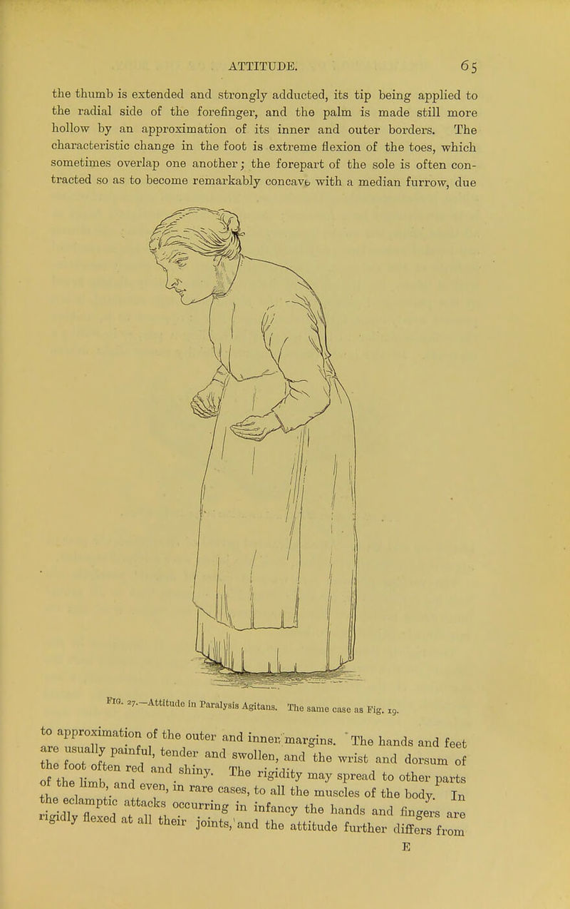 the thumb is extended and strongly adducted, its tip being applied to the radial side of the forefinger, and the palm is made still more hollow by an approximation of its inner and outer borders. The characteristic change in the foot is extreme flexion of the toes, which sometimes overlap one another; the forepart of the sole is often con- tracted so as to become remarkably concave with a median furrow, due Fio. 27.-Attitmle in Paralysis Agitaus. The same case as Kg. 19. to approximation of the outer and inner margins.  The hands and feet ZZ^^^^f^ -  dorsum of t « and < -2 c-e »=a to other parts igxdly flexed at all their joints, and the attitude further differs from E