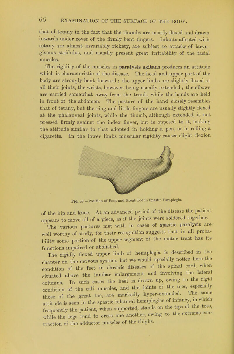 that of tetany in the fact that the thumbs are mostly flexed and drawn inwards under cover of the firmly bent fingers. Infants affected with tetany are almost invariably rickety, are subject to attacks of laryn- gismus stridulus, and usually present great irritability of the facial muscles. The rigidity of the muscles in paralysis agitans produces an attitude which is characteristic of the disease. The head and upper part of the body are strongly bent forward; the upper limbs are slightly flexed at all their joints, the wrists, however, being usually extended; the elbows are carried somewhat away from the trunk, while the hands are held in front of the abdomen. The posture of the hand closely resembles that of tetany, but the ring and little fingers are usually slightly flexed at the phalangeal joints, while the thumb, although extended, is not pressed firmly against the index finger, but is opposed to it, making the attitude similar to that adopted in holding a pen, or in rolling a cigarette. In the lower limbs muscular rigidity causes slight flexion FIG. 28.—Position of Foot and Great Toe in Spastic Paraplegia. of the hip and knee. At an advanced period of the disease the patient appears to move all of a piece, as if the joints were soldered together. The various postures met with in cases of spastic paralysis are well worthy of study, for their recognition suggests that in all proba- bility some portion of the upper segment of the motor tract has its functions impaired or abolished. The rigidly flexed upper limb of hemiplegia is described in the chapter on the nervous system, but we would specially notice here the condition of the feet in chronic diseases of the spinal cord, when situated above the lumbar enlargement and involving the lateral columns. In such cases the heel is drawn up, owing to the rigid condition of the calf muscles, and the joints of the toes, especially those of the great toe, are markedly hyper-extended. The same attitude is seen in the spastic bilateral hemiplegias of infancy, in which frequently the patient, when supported, stands on the tips of the toes, while the legs tend to cross one another, owing to the extreme con- traction of the adductor muscles of the thighs.