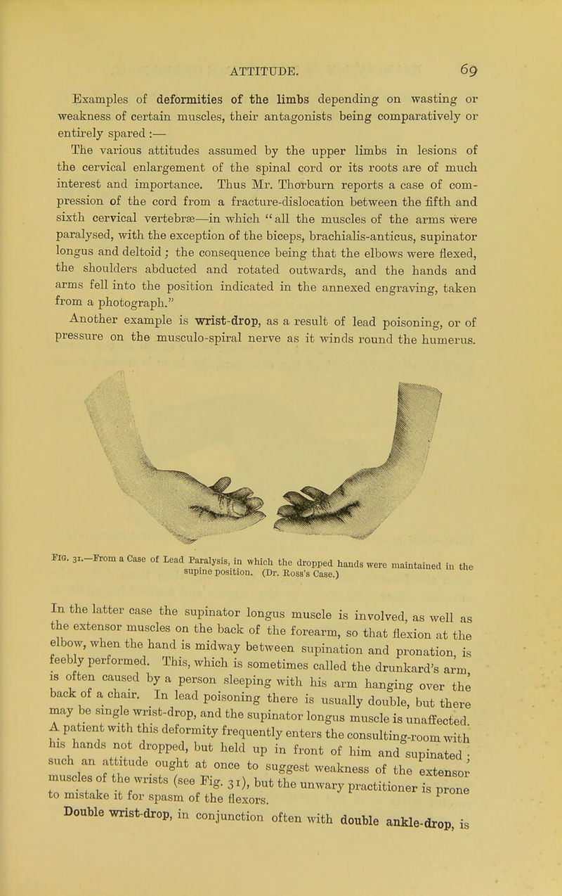 Examples of deformities of the limbs depending on wasting or weakness of certain muscles, their antagonists being comparatively or entirely spared :— The various attitudes assumed by the upper limbs in lesions of the cervical enlargement of the spinal cord or its roots are of much interest and importance. Thus Mr. Thorburn reports a case of com- pression of the cord from a fracture-dislocation between the fifth and sixth cervical vertebrae—in which all the muscles of the arms were paralysed, with the exception of the biceps, brachialis-anticus, supinator longus and deltoid ; the consequence being that the elbows were flexed, the shoulders abducted and rotated outwards, and the hands and arms fell into the position indicated in the annexed engraving, taken from a photograph. Another example is wrist-drop, as a result of lead poisoning, or of pressure on the musculo-spiral nerve as it winds round the humerus. Fro. 31-irrom a Case of Lead Paralysis, in which the dropped hands were maintained in the supine position. (Dr. Ross's Case.) In the latter case the supinator longus muscle is involved, as well as the extensor muscles on the back of the forearm, so that flexion at the elbow, when the hand is midway between supination and pronation is feebly performed. This, which is sometimes called the drunkard's arm is often caused by a person sleeping with his arm hanging over the back of a chair. In lead poisoning there is usually double, but there may be single wrist-drop, and the supinator longus muscle is unaffected A patient with this deformity frequently enters the consulting-room with his hands not dropped, but held up in front of him and supinated • such an attitude ought at once to suggest weakness of the extend muscles of the wrists (see Fig. 3 r), but the unwary practitioner is pron to mistake it for spasm of the flexors. P Double wrist-drop, in conjunction often with double ankle-drop, is