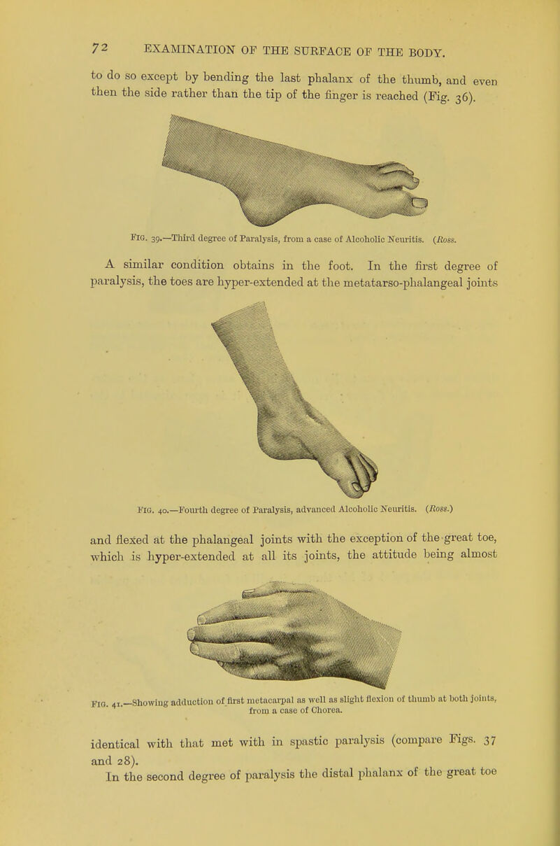 to do so except by bending the last phalanx of the thumb, and even then the side rather than the tip of the finger is reached (Fig. 36). p'/, ■ ^ Fig. 39.—Third degree of Paralysis, from a case of Alcoholic Neuritis. (Ross. A similar condition obtains in the foot. In the first degree of paralysis, the toes are hyper-extended at the metatarso-phalangeal joints Fig. 40.— Fourth degree of Paralysis, advauced Alcoholic Neuritis. (Ross.) and flexed at the phalangeal joints with the exception of the great toe, which is hyper-extended at all its joints, the attitude being almost FIG. 41.—Showing adduction of .first metacarpal as well as slight flexion of thumb at both joints, from a case of Chorea. identical with that met with in spastic paralysis (compare Figs. 37 and 28). In the second degree of paralysis the distal phalanx of the great toe