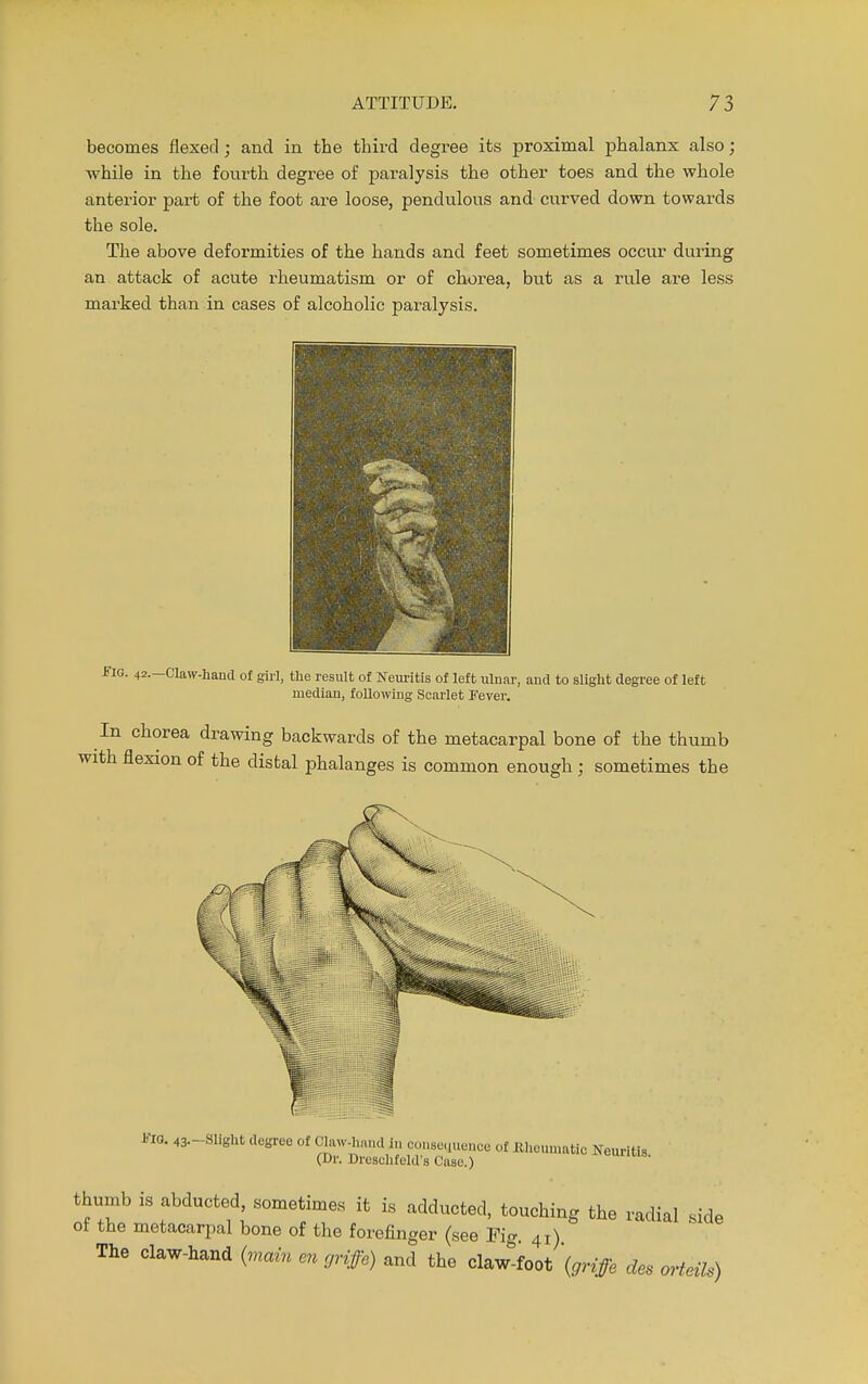 becomes flexed; and in the third degree its proximal phalanx also; while in the fourth degree of paralysis the other toes and the whole anterior part of the foot are loose, pendulous and curved down towards the sole. The above deformities of the hands and feet sometimes occur during an attack of acute rheumatism or of chorea, but as a rule are less marked than in cases of alcoholic paralysis. -Fig. 42.—Claw-hand of girl, the result of Neuritis of left ulnar, and to slight degree of left median, following Scarlet Fever. In chorea drawing backwards of the metacarpal bone of the thumb with flexion of the distal phalanges is common enough ; sometimes the no. 43-Slight degree of Claw-hand in consequence of Eheumatdc Neuritis (Dr. Droschfeld's Case.) thumb is abducted sometimes it is adducted, touching the radial side of the metacarpal bone of the forefinger (see Pig 41) The claw-hand (nudn en griffe) and the claw'foot \griffe des orteUs)