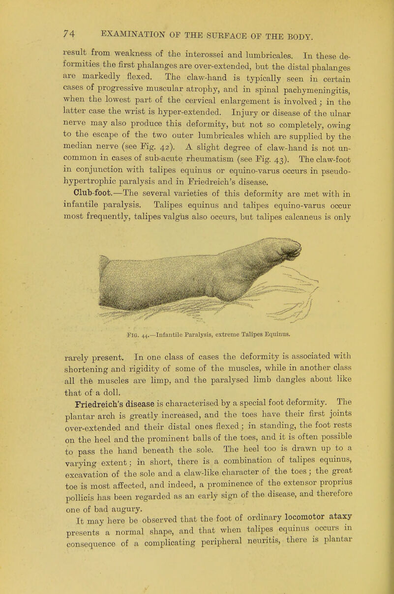 result from weakness of the interossei and lumbricales. In these de- formities the first phalanges are over-extended, but the distal phalanges are markedly flexed. The claw-hand is typically seen in certain cases of progressive muscular atrophy, and in spinal pachymeningitis, when the lowest part of the cervical enlargement is involved; in the latter case the wrist is hyper-extended. Injury or disease of the ulnar nerve may also produce this deformity, but not so completely, owing to the escape of the two outer lumbricales which are supplied by the median nerve (see Fig. 42). A slight degree of claw-hand is not un- common in cases of sub-acute rheumatism (see Pig. 43). The claw-foot in conjunction with talipes equinus or equino-varus occurs in pseudo- hypertrophic paralysis and in Friedreich's disease. Club-foot.—The several varieties of this deformity are met with in infantile paralysis. Talipes equinus and talipes equino-varus occur most frequently, talipes valgus also occurs, but talipes calcaneus is only Flu. 44.—Infantile Paralysis, extreme Talipes Equinus. rarely present. In one class of cases the deformity is associated with shortening and rigidity of some of the muscles, while in another class all the muscles are limp, and the paralysed limb dangles about like that of a doll. Friedreich's disease is characterised by a special foot deformity. The plantar arch is greatly increased, and the toes have their first joints over-extended and their distal ones flexed; in standing, the foot rests on the heel and the prominent balls of the toes, and it is often possible to pass the hand beneath the sole. The heel too is drawn up to a varying extent; in short, there is a combination of talipes equinus, excavation of the sole and a claw-like character of the toes; the great toe is most affected, and indeed, a prominence of the extensor proprius pollicis has been regarded as an early sign of the disease, and therefore one of bad augury. It may here be observed that the foot of ordinary locomotor ataxy presents a normal shape, and that when talipes equinus occurs in consequence of a complicating peripheral neuritis, there is plantar