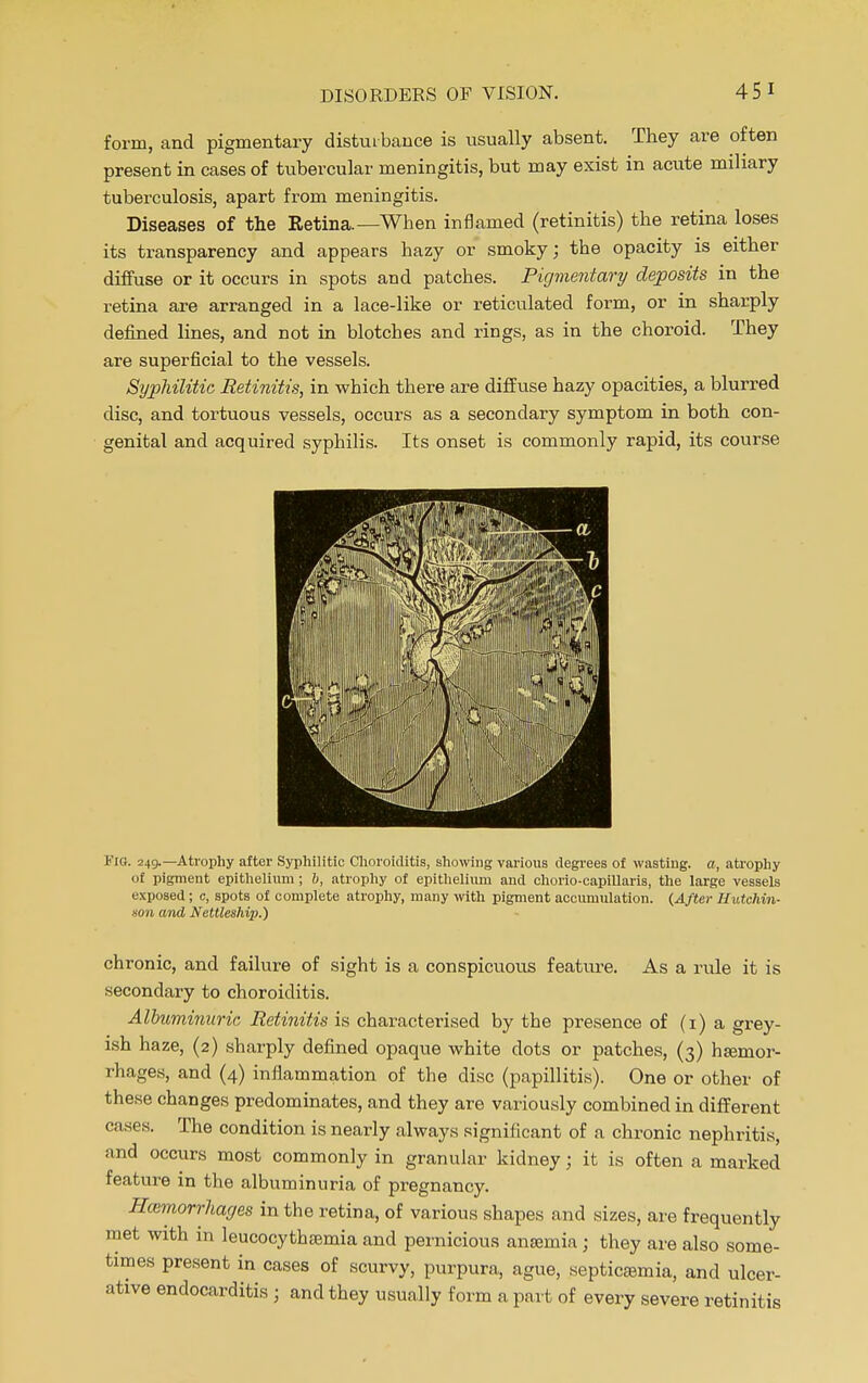 form, and pigmentary disturbance is usually absent. They are often present in cases of tubercular meningitis, but may exist in acute miliary tuberculosis, apart from meningitis. Diseases of the Retina.—When inflamed (retinitis) the retina loses its transparency and appears hazy or smoky; the opacity is either diffuse or it occurs in spots and patches. Pigmentary deposits in the retina are arranged in a lace-like or reticulated form, or in sharply defined lines, and not in blotches and rings, as in the choroid. They are superficial to the vessels. Syphilitic Retinitis, in which there are diffuse hazy opacities, a blurred disc, and tortuous vessels, occurs as a secondary symptom in both con- genital and acquired syphilis. Its onset is commonly rapid, its course Fig. 249.—Atrophy after Syphilitic Choroiditis, showing various degrees of wasting, a, atrophy of pigment epithelium ; h, atrophy of epithelium and chorio-capillaris, the large vessels exposed; c, spots of complete atrophy, many with pigment accumulation. (After Hutchin- son and Nettleshij).) chronic, and failure of sight is a conspicuous feature. As a rule it is secondary to choroiditis. Albuminuric Retinitis is characterised by the presence of (1) a grey- ish haze, (2) sharply defined opaque white clots or patches, (3) haemor- rhages, and (4) inflammation of the disc (papillitis). One or other of these changes predominates, and they are variously combined in different rases. The condition is nearly always significant of a chronic nephritis, and occurs most commonly in granular kidney j it is often a marked feature in the albuminuria of pregnancy. Hemorrhages in the retina, of various shapes and sizes, are frequently met with in leucocythsemia and pernicious anajmia ; they are also some- times present in cases of scurvy, purpura, ague, septicajmia, and ulcer- ative endocarditis • and they usually form a part of every severe retinitis