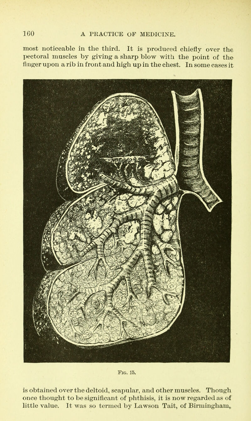 most noticeable in the third. It is produced chiefly over the pectoral muscles by giving a sharp blow with the point of the finger upon a rib in front and high up in the chest. In some cases it Fig. 15. is obtained over the deltoid, scapular, and other muscles. Though once thought to be significant of phthisis, it is now regarded as of little value. It was so termed by Lawson Tait, of Birmingham,