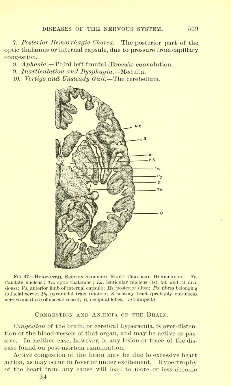 7. Posterior Hemorrliagic Chorea.—The posterior joart of the optic thalamus or internal capsule, due to pressure from capillary congestion. 8. Aphasia.—T\\\Y(}i left frontal (Broca's) convolution. 0. InarUGulation and Dysphagia.—MeduUa.. 10. Vertigo and Unsteady Gait—The cerebellum. Fig. 47.—Horizontal Section through Right Cerebral Hemisphere. iVc, Caudate nucleus ; Th, optic thalamus ; Lk, lenticulai- nucleus (1st, 2d, and 3d divi- sions); F.s, anterior limb of internal capsule; i?s, posterior ditto; i^a, fibres belonging to facial nerve; F?/, pyramidal tract (motor); S, sensory tract (probably cutaneous nerves and those of special sense); O, occipital lobes. i.Striimpell.) Congestion and Anemia of the Brain. Congestion of the brain, or cerebral hypersemia., is over-disten- tion of the blood-vessels of that organ, and may be active or pas- sive. In neither case, however, is any lesion or trace of the dis- ease found on post-mortem examination. Active congestion of the brain may be due to excessive heart action, as may occur in fever or under excitement. Hypertrophy of the heart from any cause will lead to more or less chronic 34