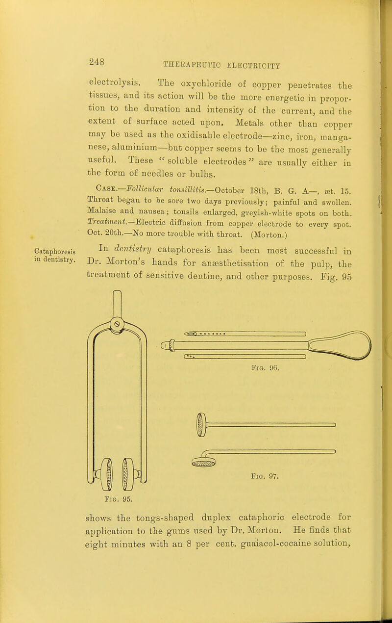 Cntaphoresis iu dentistry. electrolysis. The oxychloride of copper penetrates the tissues, and its action will be the more energetic in propor- tion to the duration and intensity of the current, and the extent of surface acted upon. Metals other than copper may be used as the oxidisable electrode—zinc, iron, manga- nese, aluminium—but copper seems to be the most generally useful. These  soluble electrodes are usually either iu the form of needles or bulbs. Case.—Follicular tonsillitis.—October 18th, B. G. A—, set. 15. Tliroat began to be sore two days previously; painful and swollen. Malaise and nausea; tonsils enlarged, greyisli-white spots on both. Treatment— Electric diffusion from copper electrode to every spot. Oct. 20th.—No more trouble with throat. (Morton.) In dentistry cataphoresis has been most successful in Dr. Morton's hands for anaasthetisation of the pulp, the treatment of sensitive dentine, and other purposes. Fig. 95 Fig. 96. Fig. 97. Fig. 95. shows the tongs-shaped duplex cataphoric electi-ode for application to the gums used by Dr. Morton. He finds that eight minutes with an 8 per cent, guaiacol-cocaine solution,