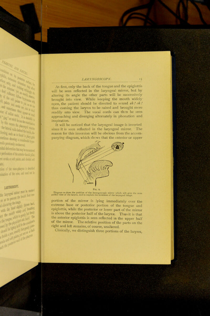 h-t first, only the back of the tongue and the epiglottis will be seen reflected in the laryngeal mirror, but by altering its angle the other parts will be successively brought into view. While keeping the mouth widely open, the patient should be directed to sound eh ! eh ! thus causing the larynx to be raised and brought more readily mto view. The vocal cords can then be seen approaching and diverging alternately in phonation and inspiration. It will be noticed that the laryngeal image is inverted since it is seen reflected in the laryngeal mirror. ' The reason for this inversion will be obvious from the accom- panying diagram, which shows that the anterior or upper Fig. 6. Diagram to show the position of the laryu^oscopic mirror which will give the most perfect view of the larynx, and to explain the inversion of the laryngeal image. portion of the mirror is lying immediately over the e.Ktreme base or posterior portion of the tongue and epiglottis, while the posterior or lower part of the mirror is above the posterior half of the larynx. Thus it is that the anterior epiglottis is seen reflected in the upper half of the mirror. The relative position of the parts on the right and left remains, of course, unaltered. Clinically, we distinguish three portions of the larynx,