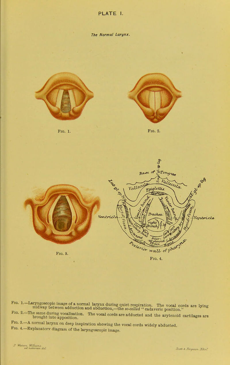 PLATE I. The Normal Larynx. FlQ. 1. Fig. 2. Fig. 8. ^ vycUJ^ of Fig. 4. Pio. l.-Laryngoscopic image of a normal larynx during quiet respiration. The vocal cords are Ivine midway between adduction and abduction,-tfie so-called  cadkveric poXon  ^ ^ F:o. The vocal cords are addueted and the arytenoid cartilages are Fro. 3.-A normal larynx on deep inspiration showing the vocal cords widely abducted. Pig. 4.—Bxplanatorv diagram of the laryngoscopic image. ad tuitnrnm dtt Scott A Fer^tm, JWmt