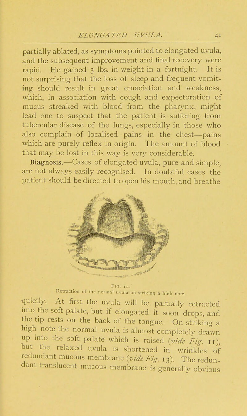 partially ablated, as symptoms pointed to elongated uvula, and the subsequent improvement and final recovery were rapid. He gained 3 lbs. in weight in a fortnight. It is not surprising that the loss of sleep and frequent vomit- ing should result in great emaciation and weakness, which, in association with cough and expectoration of mucus streaked with blood from the pharynx, might lead one to suspect that the patient is suffering from tubercular disease of the lungs, especially in those who also complain of localised pains in the chest—pains which are purely reflex in origin. The amount of blood that may be lost in this way is ver}^ considerable. Diagnosis.—Cases of elongated uvula, pure and simple, are not always easily recognised. In doubtful cases the patient should be directed to open his mouth, and breathe Y\r,. II. Retraction of the normal uvula on striking a higli note. quietly. At first the uvula will be partially retracted into the soft palate, but if elongated it soon drops, and the tip rests on the back of the tongue. On striking a high note the normal uvula is almost completely drawn up mto the soft palate which is raised (^oide Fig. 11), but the relaxed uvula is shortened in wrinkles of redundant mucous membrane {vide Fig. 13). The redun- dant translucent mucous membrano is generally obvious