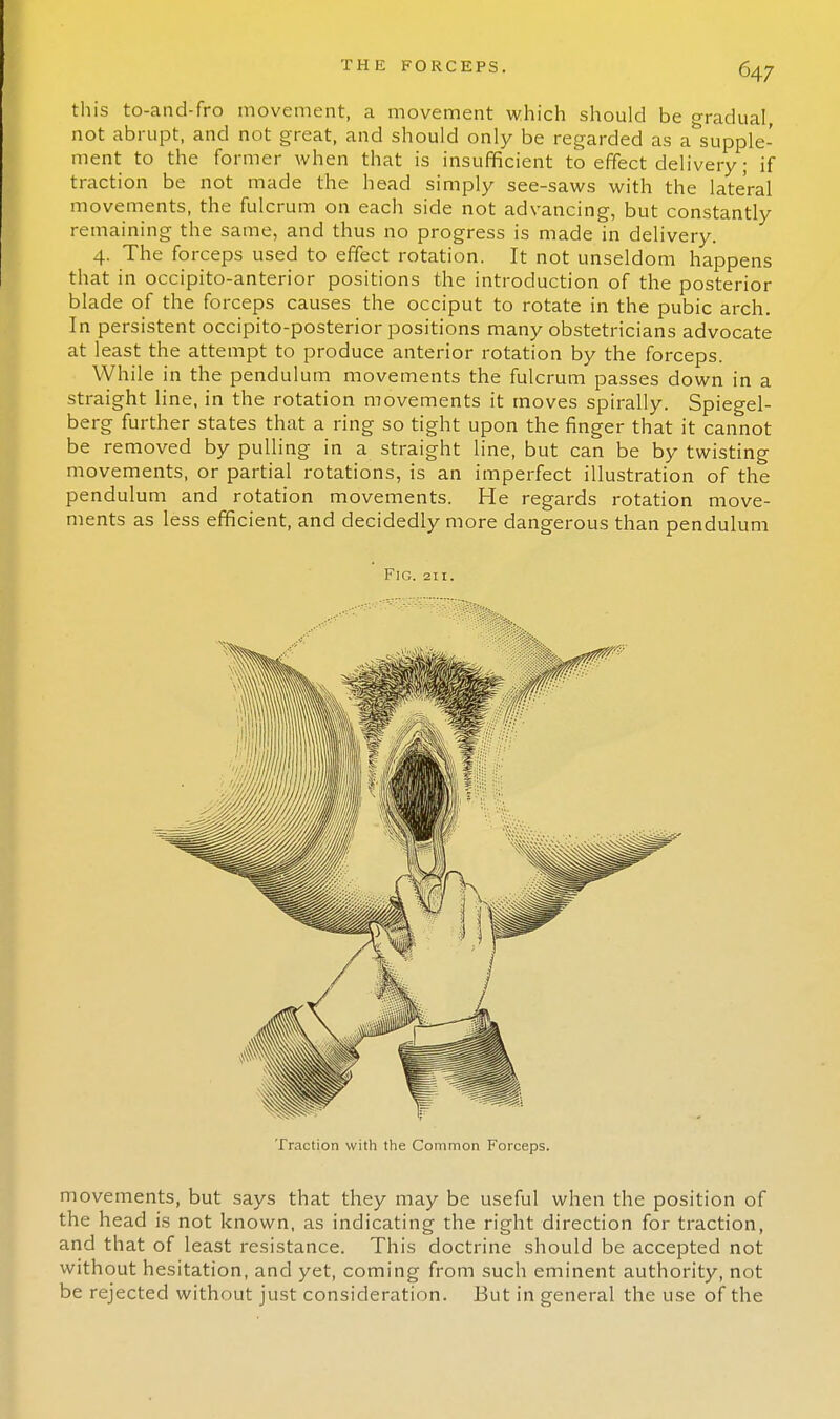 this to-and-fro movement, a movement which should be gradual, not abrupt, and not great, and should only be regarded as a'supple- ment to the former when that is insufficient to effect delivery; if traction be not made the head simply see-saws with the lateral movements, the fulcrum on each side not advancing, but constantly remaining the same, and thus no progress is made in delivery. 4. The forceps used to effect rotation. It not unseldom happens that in occipito-anterior positions the introduction of the posterior blade of the forceps causes the occiput to rotate in the pubic arch. In persistent occipito-posterior positions many obstetricians advocate at least the attempt to produce anterior rotation by the forceps. While in the pendulum movements the fulcrum passes down in a straight line, in the rotation movements it moves spirally. Spiegel- berg further states that a ring so tight upon the finger that it cannot be removed by pulling in a straight line, but can be by twisting movements, or partial rotations, is an imperfect illustration of the pendulum and rotation movements. He regards rotation move- ments as less efficient, and decidedly more dangerous than pendulum Fig. 211. Traction with the Common Forceps. movements, but says that they may be useful when the position of the head is not known, as indicating the right direction for traction, and that of least resistance. This doctrine should be accepted not without hesitation, and yet, coming from such eminent authority, not be rejected without just consideration. But in general the use of the