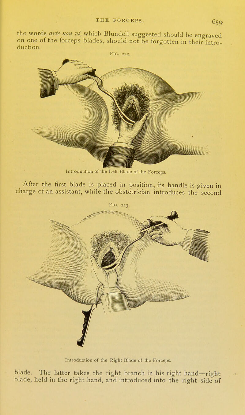 the words arte non vi, which Blundell suggested should be engraved on one of the forceps blades, should not be forgotten in their intro- duction. Fig. 222. Introduction of the Left Blade of the Forceps. After the first blade is placed in position, its handle is given in charge of an assistant, while the obstetrician introduces the second Fk;. 223. Introduction of the Right Blade of the Forceps. blade. The latter takes the right branch in his right hand—right blade, held in the right hand, and introduced into the right side of