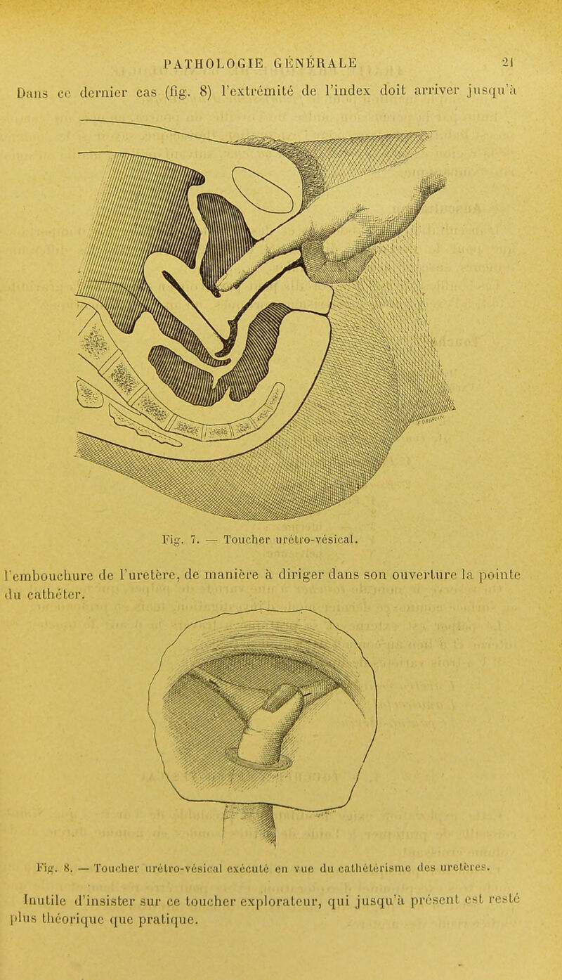 Dans ce dernier cas (fig. 8) l'extrémité de l'index doit arriver jusqu'à Fig. s. — Toucher urétro-vésical exécuté en vue du cathétérisme des uretères. Inutile d'insister sur ce toucher explorateur, qui jusqu'à présent esl resté plus théorique que pratique.