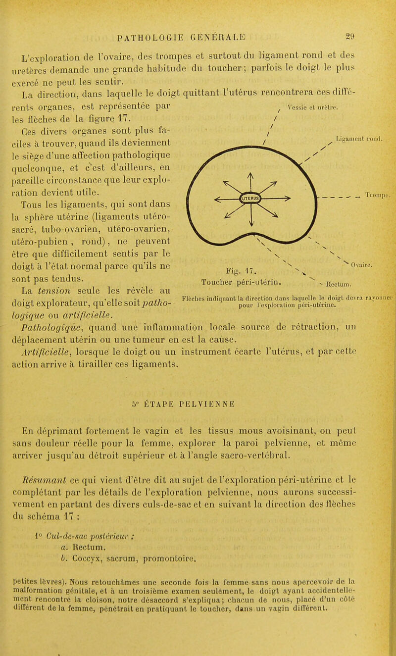 Vessie et urètre. L'exploration de l'ovaire, des trompes et surtout du ligament rond et des uretères demande une grande habitude du toucher; parfois le doigt le plus exercé ne peut les sentir. La direction, dans laquelle le doigt quittant l'utérus rencontrera ces diffé- rents organes, est représentée par les flèches de la figure 17. Ces divers organes sont plus fa- ciles à trouver, quand ils deviennent le siège d'une affection pathologique quelconque, et c'est d'ailleurs, en pareille circonstance que leur explo- ration devient utile. Tous les ligaments, qui sont dans la sphère utérine (ligaments utéro- sacré, tubo-ovarien, utéro-ovarien, utéro-pubien , rond), ne peuvent être que difficilement sentis par le doigt à l'état normal parce qu'ils ne sont pas tendus. La tension seule les révèle au doigt explorateur, qu'elle soit patho- logique ou artificielle. Pathologique, quand une inflammation locale source de rétraction, un déplacement utérin ou une tumeur en est la cause. Artificielle, lorsque le doigt ou un instrument écarte l'utérus, et par cette action arrive à tirailler ces ligaments. Ligament rond. Trompe. Fig. 17. Toucher péri-utérin. Ovaire. Rectun Flèches indiquant la direction dans laquelle le doigt devra rayonner pour l'exploration péri-utérine. 5 ÉTAPE PELVIENNE En déprimant fortement le vagin et les tissus mous avoisinant, on peut sans douleur réelle pour la femme, explorer la paroi pelvienne, et même arriver jusqu'au détroit supérieur et à l'angle sacro-vertébral. Résumant ce qui vient d'être dit au sujet de l'exploration péri-utérine et le complétant par les détails de l'exploration pelvienne, nous aurons successi- vement en partant des divers culs-de-sac et en suivant la direction des flèches du schéma 17 : i Cal-dc-sac postérieur : a. Rectum. b. Coccyx, sacrum, promontoire. petites lèvres). Nous retouchâmes une seconde fois la femme sans nous apercevoir de la malformation génitale, et à un troisième examen sculément, le doigt ayant accidentelle- ment rencontré la cloison, notre désaccord s'expliqua; chacun de nous, placé d'un côté différent delà femme, pénétrait en pratiquant le toucher, dans un vagin différent.