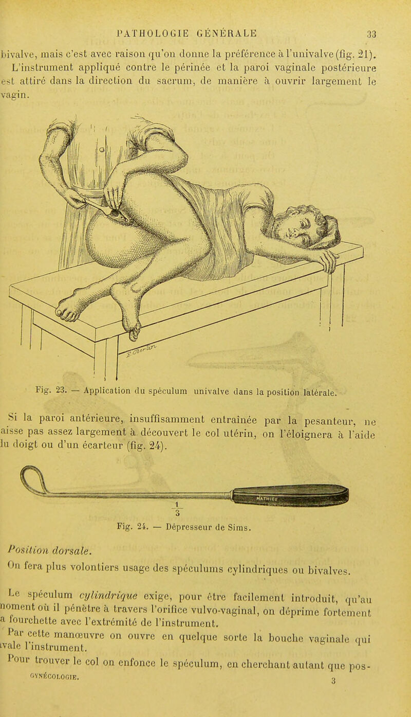 bivalve, mais c'est avec raison qu'on donne la préférence à l'univalve (fig. 21). L'instrument appliqué contre le périnée et la paroi vaginale postérieure est attiré dans la direction du sacrum, de manière à ouvrir largement le vagin. Fig. 23. — Application du spéculum univalve clans la position latérale. Si la paroi antérieure, insuffisamment entraînée par la pesanteur, ne aisse pas assez largement à découvert le col utérin, on l'éloignera cà Laide lu doigt ou d'un écarteur (fig. 24). Fig. 24. — Dépresseur de Sims. Position dorsale. On fera plus volontiers usage des spéculums cylindriques ou bivalves. Le spéculum cylindrique exige, pour être facilement introduit, qu'au nomentoù il pénètre à travers l'orifice vulvo-vaginal, on déprime fortement a fourchette avec l'extrémité de l'instrument. Par celte manœuvre on ouvre en quelque sorte la bouche vaginale nui tvale 1 instrument. Pour trouver le col on enfonce le spéculum, en cherchant autant que pos- GYNÉCOI.OGIE. g