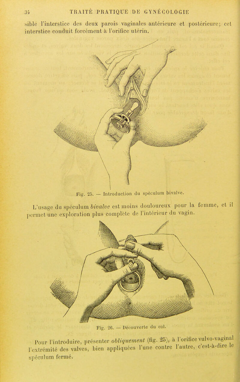 sible l'interstice des deux parois vaginales antérieure et postérieure; cet interstice conduit forcément à l'orifice utérin. Fig. 25. — Introduction du spéculum bivalve. L'usage du spéculum bivalve est moins douloureux pour la femme, et permet une exploration plus complète de l'intérieur du vagin. pjrr. 26. — Découverte du col. Pour l'introduire, présenter obliquement (fig. 25), à l'orifice vulvo-vaginal l'extrémité des valves, bien appliquées l'une contre l'autre, c'est-a-chre le spéculum fermé.