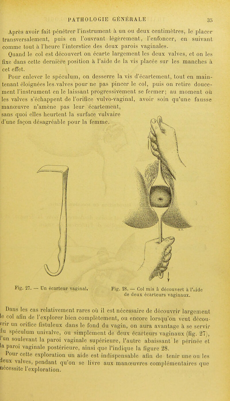 Après avoir fait pénétrer l'instrument à un ou deux centimètres, le placer transversalement, puis en l'ouvrant légèrement, l'enfoncer, en suivant comme tout à l'heure l'interstice des deux parois vaginales. Quand le col est découvert on écarte largement les deux valves, et on les fixe dans cette dernière position à l'aide de la vis placée sur les manches à cet effet. Pour enlever le spéculum, on desserre la vis d'écartement, tout en main- tenant éloignées les valves pour ne pas pincer le col, puis on retire douce- ment l'instrument en le laissant progressivement se fermer; au moment où les valves s'échappent de l'orifice vulvo-vaginal, avoir soin qu'une fausse manœuvre n'amène pas leur écartement, Fig. 27. — Un écarteur vaginal. Fig. 28. — Col mis à découvert à l'aide de deux écarteurs vaginaux. Dans les cas relativement rares où il est nécessaire de découvrir largement le col afin de l'explorer bien complètement, ou encore lorsqu'on veut décou- vrir un orifice fistuleux dans le fond du vagin, on aura avantage à se servir au spéculum imivalvc, ou simplement de deux écarteurs vaginaux (fig. 27), l'un soulevant la paroi vaginale supérieure, l'autre abaissant le périnée et 'a paroi vaginale postérieure, ainsi que l'indique la figure 28. Pour cette exploration un aide est indispensable afin de tenir une ou les tfeux valves, pendant qu'on se livre aux manœuvres complémentaires que nécessite l'exploration.