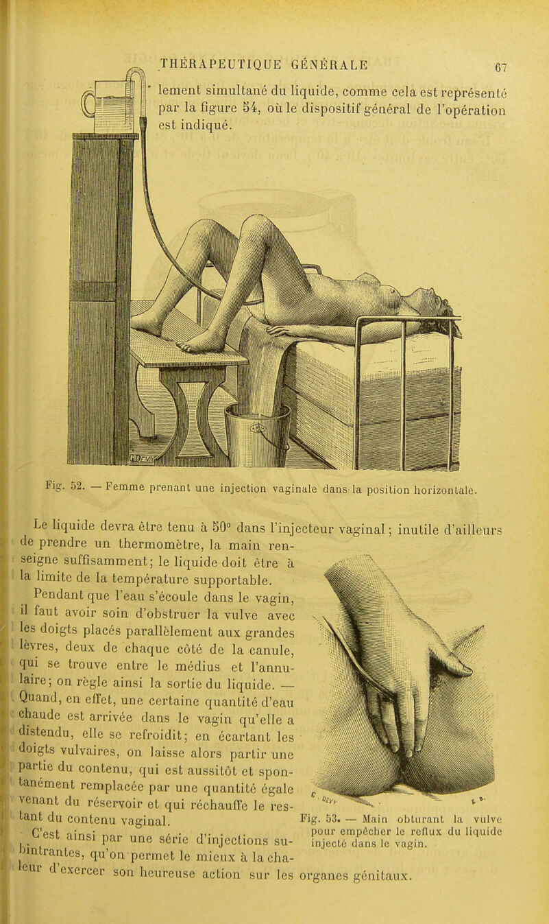 lement simultané du liquide, comme cela est représente par la figure 54, où le dispositif général de l'opération est indiqué. 67 Le liquide devra être tenu à 50° dans l'injecteur vaginal ; inutile d'ailleurs de prendre un thermomètre, la main ren- seigne suffisamment; le liquide doit être à la limite de la température supportable. Pendant que l'eau s'écoule dans le vagin, il faut avoir soin d'obstruer la vulve avec les doigts placés parallèlement aux grandes lèvres, deux de chaque côté de la canule, qui se trouve entre le médius et l'annu- laire; on règle ainsi la sortie du liquide. — Quand, en effet, une certaine quantité d'eau chaude est arrivée dans le vagin qu'elle a distendu, elle se refroidit; en écartant les doigts vulvaircs, on laisse alors partir une partie du contenu, qui est aussitôt et spon- tanément remplacée par une quantité égale venant du réservoir et qui réchauffe le res- tant du contenu vaginal. Cest ainsi par une série d'injections su- omtrantes, qu'on permet le mieux à lachà- eur d'exercer son heureuse action sur les organes génitaux Fig. 53. — Main obturant la vulve pour empêcher le reflux du liquide injecté dans le vagin.