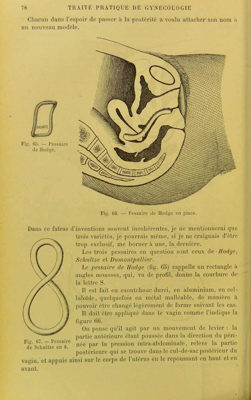 Chacun dans l'espoir de passer à la postérité a voulu attacher son nom h un nouveau modèle. Fig. 65. — Pessaire de Ilodge. Fig. 66. — Pessaire de Hodge en place. Dans ce fatras d'inventions souvent incohérentes, je ne mentionnerai que trois variétés, je pourrais même, si je ne craignais d'être trop exclusif, me borner à une, la dernière. Les trois pessaires en question sont ceux de Hodge, Schultze et Dumontpallier. Le pessaire de Hodge (fig-. 65) rappelle un rectangle à angles mousses, qui, vu de profil, donne la courbure de la lettre S. Il est fait en caoutchouc durci, en aluminium, en cel- luloïde, quelquefois en métal malléable, de manière à pouvoir être changé légèrement de forme suivant les cas. Il doit être appliqué dans le vagin comme l'indique la figure 66. On pense qu'il agit par un mouvement de levier : la partie antérieure étant poussée dans la direction du péri- née par la pression inlra-abdominale, relève la partie postérieure qui se trouve dans le cul-de-sac postérieur du vagin, et appuie ainsi sur le corps de l'utérus en le repoussant en haut et en avant. Fig. 67. — Fessaire de Schultze en 8.