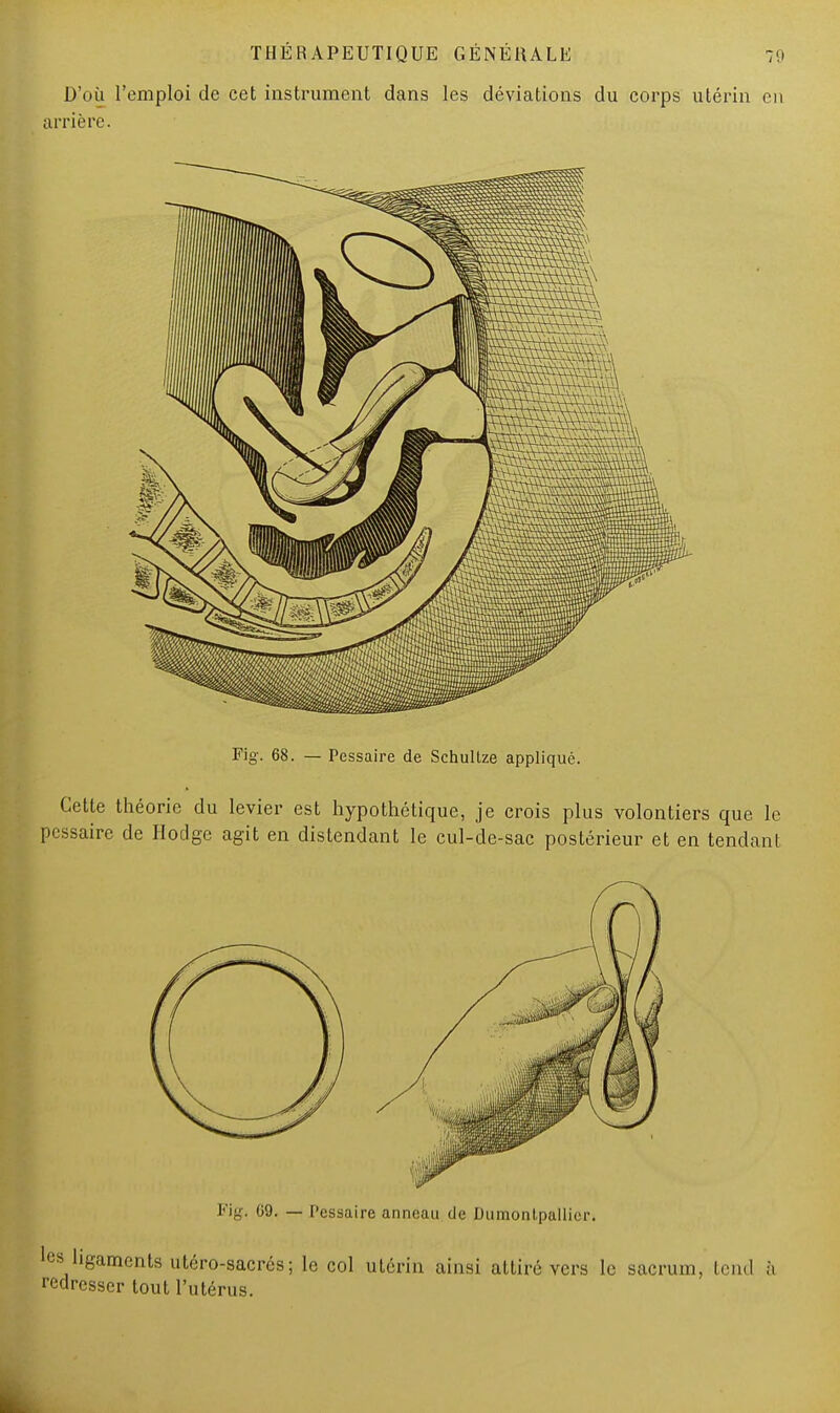 D'où l'emploi de cet instrument dans les déviations du corps utérin en arrière. Fig. 68. — Pessaire de Schullze appliqué. Cette théorie du levier est hypothétique, je crois plus volontiers que le pessaire de Hodge agit en distendant le cul-de-sac postérieur et en tendant Fig, G9. — Pessaire anneau de Dumonlpallicr. les ligaments utéro-sacrés; le col utérin ainsi attiré vers le sacrum, tend à redresser tout l'utérus.