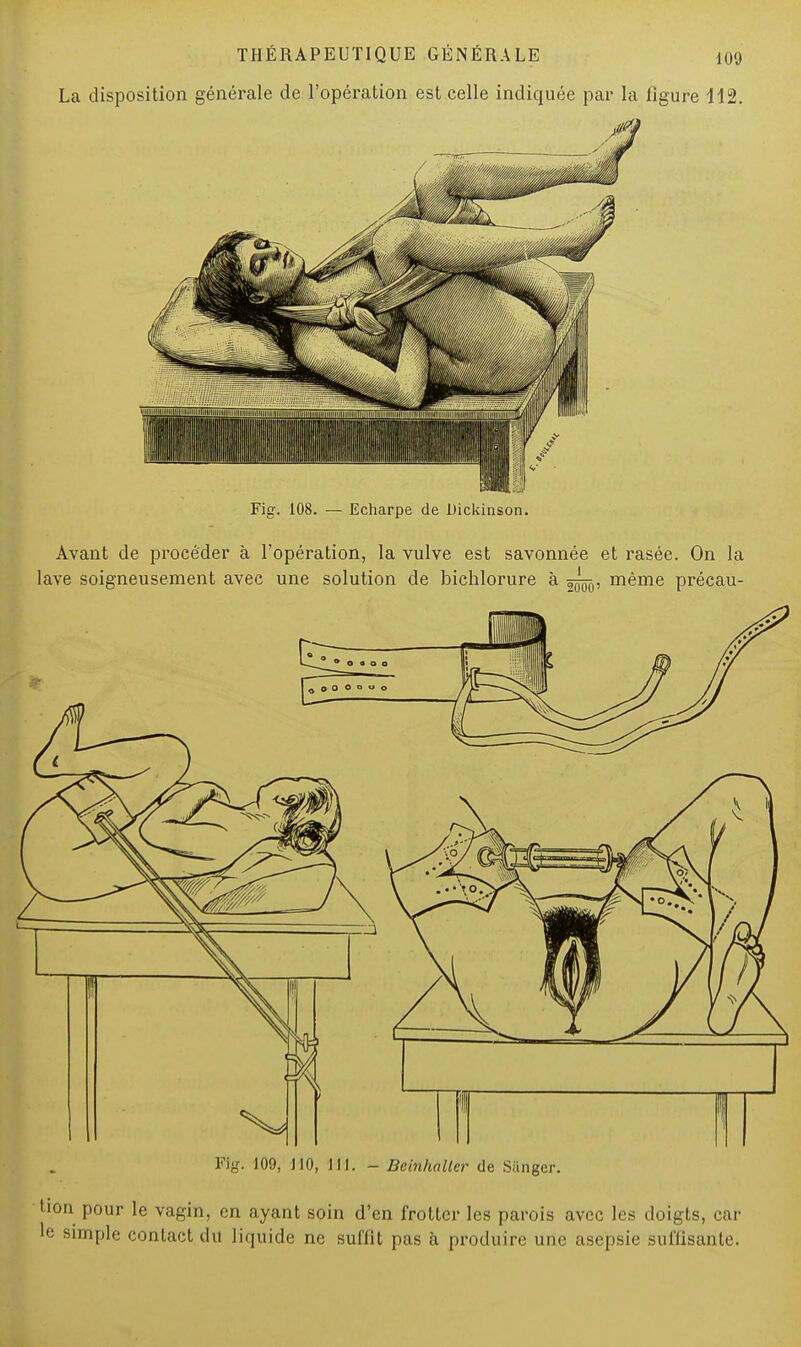 La disposition générale de l'opération est celle indiquée par la figure 112. Fig. 108. — Echarpe de Dickinson. Avant de procéder à l'opération, la vulve est savonnée et rasée. On la lave soigneusement avec une solution de bichlorure à même précau- Fig. 109, 110, 111. - Bcinhaller de Siinger. tion pour le vagin, en ayant soin d'en frotter les parois avec les doigts, car le simple contact du liquide ne suffit pas à produire une asepsie suffisante.