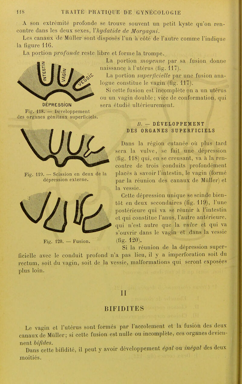 A son extrémité profonde se trouve souvent un petit kyste qu'on ren- contre dans les deux sexes, Yhydalide de Morgagni. Les canaux de Millier sont disposés l'un à côté de l'autre comme l'indique la figure 11G. La portion profonde reste libre et forme la trompe. La portion moyenne par sa fusion donne naissance à l'utérus (fig. 117). La portion superficielle par une fusion ana- logue constitue le vagin (fig. 117). Si cette fusion est incomplète on a un utérus ou un vagin double ; vice de conformation, qui DÉPRESSION sera étudié ultérieurement. Fig. 118. — Développement des organes génitaux superficiels. B. — DÉVELOPPEMENT DES ORGANES SUPERFICIELS Dans la région cutanée où plus tard sera la vulve, se fait une dépression (fig. 118) qui, en se creusant, va à la ren- contre de trois conduits profondément Fig. 119. — Scission en deux de la placés à savoir l'intestin, le vagin (formé dépression externe. par ia réunion des canaux de Mùller) et la vessie. Cette dépression unique se scinde bien- tôt en deux secondaires (fig. 119), l'une postérieure qui va se réunir à l'intestin et qui constitue l'anus, l'autre antérieure, qui n'est autre que la vulve et qui va s'ouvrir dans le vagin et dans la vessie Fig. 120. — Fusion. (fig- 120). Si la réunion de la dépression super- ficielle avec le conduit profond n'a pas lieu, il y a imperforation soit du rectum, soit du vagin, soit de la vessie, malformations qui seront exposées plus loin. II BIFIDITES Le vagin et l'utérus sont formés par l'accotement et la fusion des deux canaux de Millier; si cette fusion est nulle ou incomplète, ces organes devien- nent bifides. Dans cette bifidité, il peut y avoir développement égal ou inégal des doux moitiés.