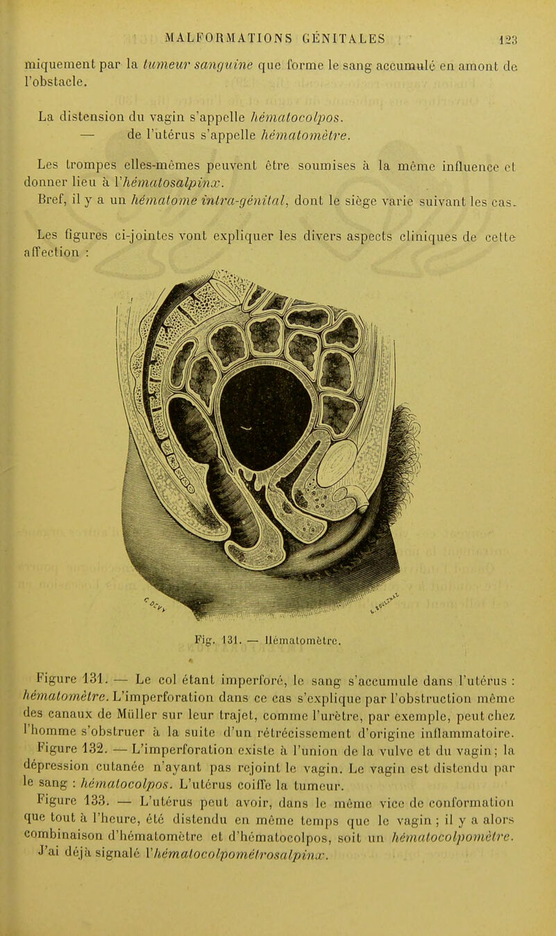 iniquement par la tumeur sanguine que forme le sang accumulé en amont de l'obstacle. La distension du vagin s'appelle hématocolpos. — de l'utérus s'appelle hématomètre. Les trompes elles-mêmes peuvent être soumises à la même influence et donner lieu à Y hémalosalpinx. Bref, il y a un hématome inlra-génilal, dont le siège varie suivant les cas. Les figures ci-jointes vont expliquer les divers aspects cliniques de celte affection : Fig. 131. — llématomètre. Figure 131. — Le col étant imperforé, le sang s'accumule dans l'utérus : llématomètre. L'imperforation dans ce cas s'explique par l'obstruction même des canaux de Millier sur leur trajet, comme l'urètre, par exemple, peut clic/, l'homme s'obstruer à la suite d'un rétrécissement d'origine inflammatoire. Figure 132. — L'imperforation existe à l'union de la vulve et du vagin; la dépression cutanée n'ayant pas rejoint le vagin. Le vagin est distendu par le sang : hématocolpos. L'utérus coiffe la tumeur. Figure 133. — L'utérus peut avoir, dans le môme vice de conformation que tout à l'heure, été distendu en même temps que le vagin ; il y a alors combinaison d'hématomètre et d'hématocolpos, soit un hematocolpomètre. J'ai déjà signalé Xhèmalocolpomélrosalpin.r.