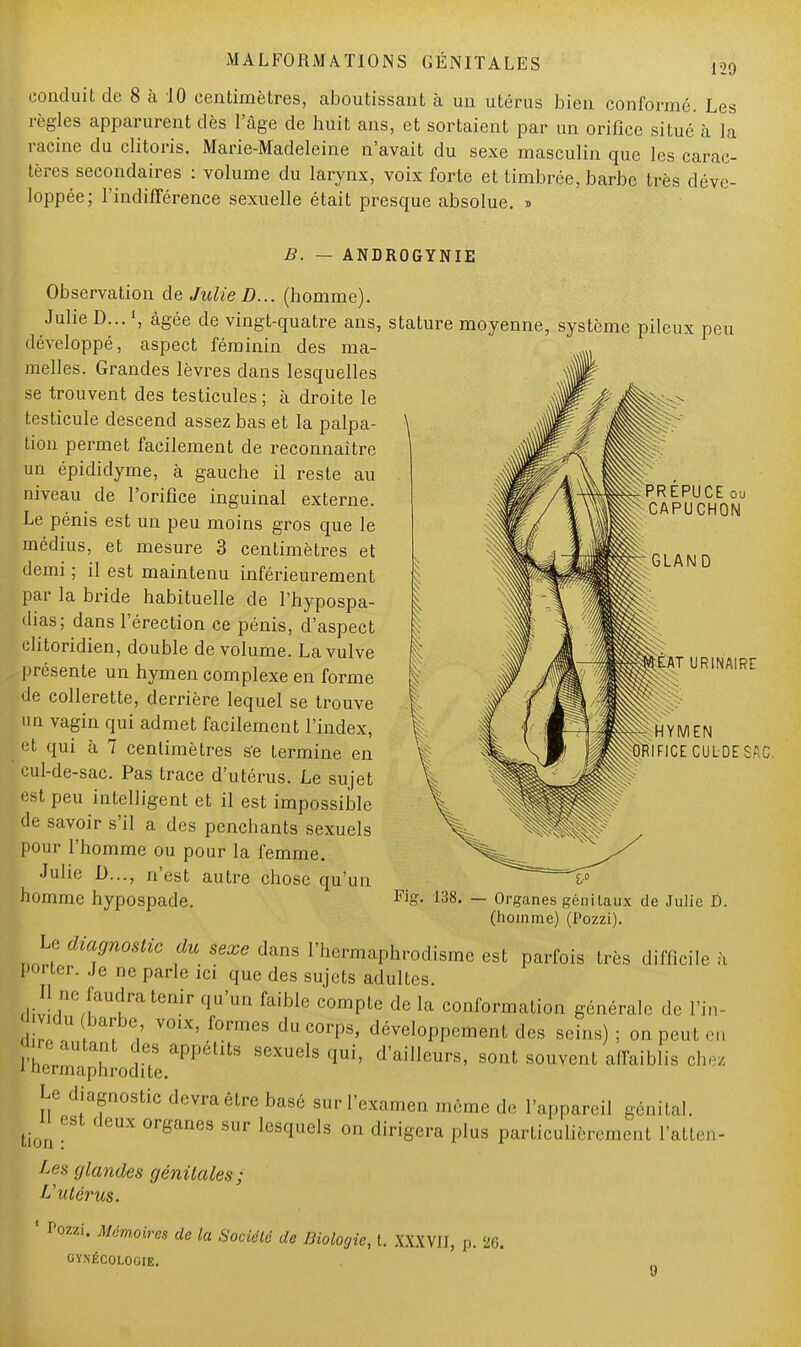 conduit de 8 à 10 centimètres, aboutissant à un utérus bien conformé. Les règles apparurent dès l'âge de huit ans, et sortaient par un orifice situé à la racine du clitoris. Marie-Madeleine n'avait du sexe masculin que les carac- tères secondaires : volume du larynx, voix forte et timbrée, barbe très déve- loppée; l'indifférence sexuelle était presque absolue. » EPUCE ou CAPUCHON GLAND B. — ANDROGYNIE Observation de Julie D... (homme). Julie D...1, âgée de vingt-quatre ans, stature moyenne, système pileux peu développé, aspect féminin des ma- melles. Grandes lèvres dans lesquelles se trouvent des testicules ; à droite le testicule descend assez bas et la palpa- tion permet facilement de reconnaître un épididyme, à gauche il reste au niveau de l'orifice inguinal externe. Le pénis est un peu moins gros que le médius, et mesure 3 centimètres et demi ; il est maintenu inférieurement par la bride habituelle de l'hypospa- dias; dans l'érection ce pénis, d'aspect clitoridien, double de volume. La vulve présente un hymen complexe en forme de collerette, derrière lequel se trouve un vagin qui admet facilement l'index, et qui à 7 centimètres s'e termine en cul-de-sac. Pas trace d'utérus. Le sujet est peu intelligent et il est impossible de savoir s'il a des penchants sexuels pour l'homme ou pour la femme. Julie D..., n'est autre chose qu'un homme hypospade. EAT URINAIRT HYMEN jft'lFICE.CUL-DESAC. Fiff. 138. - Organes génitaux de Julie D. (homme) (Pozzi). Le diagnostic du sexe dans l'hermaphrodisme est parfois très difficile a porter. Je ne parle ici que des sujets adultes. H ne faudra tenir qu'un faible compte de la conformation générale de l'in- •du barbe voix, formes du corps, développement des seins) ; on peut en STrm?hîod?to apPéhta SeXUel3qui' d'ailIe^s, sont souvent affaiblis chez Le diagnostic devra être basé sur l'examen même de l'appareil génital. t_ u est deux organes sur lesquels on dirigera plus particulièrement l'atten- tes glandes génitales; L'utérus. ' Pozzi. Mémoires de la Société de Biologie, t. XXXVII, p. 20. GYNÉCOLOGIE.