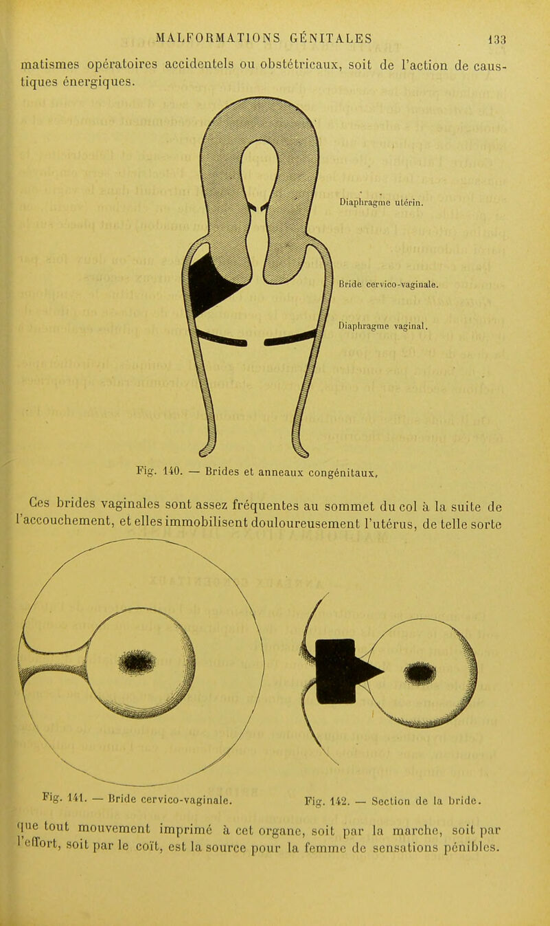 matismes opératoires accidentels ou obstétricaux, soit de l'action de caus- tiques énergiques. Fig. 140. — Brides et anneaux congénitaux, ^ Ces brides vaginales sont assez fréquentes au sommet du col à la suite de 'accouchement, et elles immobilisent douloureusement l'utérus, de telle sorte Fig. 141. — Bride cervico-vaginale. Fig. 142. — Section de la bride. que tout mouvement imprimé à cet organe, soit par la marche, soit par l' Tort, soit par le coït, est la source pour la femme de sensations pénibles.