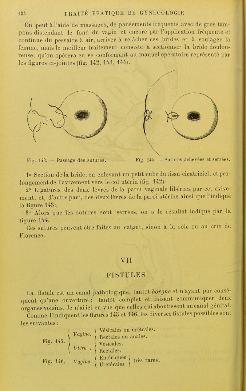 On peut à l'aide de massages, de pansements fréquents avec de gros tam- pons distendant le fond du vagin et encore par l'application fréquente et continue du pessaire à air, arriver à relâcher ces brides et à soulager la femme, mais le meilleur traitement consiste à sectionner la bride doulou- reuse, qu'on opérera en se conformant au manuel opératoire représenté par les figures ci-jointes (fig. 142, 143, 144). Fig. 143. — Passage des sutures. Fig. 144. — Sutures achevées et serrées. 1° Section delà bride, en enlevant un petit cube du tissu cicatriciel, et pro- longement de l'avivement vers le col utérin (fig. 142); 2° Ligatures des deux lèvres de la paroi vaginale libérées par cet avive- ment, et, d'autre part, des deux lèvres de la paroi utérine ainsi que l'indique la figure 143 ; 3° Alors que les sutures sont serrées, on a le résultat indiqué par la figure 144. Ces sutures peuvent être faites au catgut, sinon à la soie ou au crin de Florence. VII FISTULES La fistule est un canal pathologique, tantôt borgne et n'ayant par consé- quent qu'une ouverture ; tantôt complet et faisant communiquer deux organes voisins. Je n'aiici en vue que celles qui aboutissent au canal génital. Comme l'indiquent les figures 145 et 146, les diverses fistules possibles sont les suivantes : / . ( Vésicales ou urétrales. \ Va0ino- ( Rectales ou anales. Fi«« 145- J ( Vésicales. ( Utero . j Rectales.