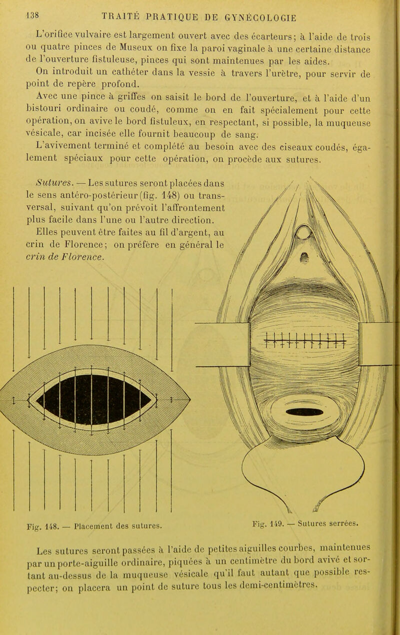 L'orifice vulvaire est largement ouvert avec des écarteurs; à l'aide de trois ou quatre pinces de Museux on fixe la paroi vaginale à une certaine distance de l'ouverture fîstuleuse, pinces qui sont maintenues par les aides. On introduit un cathéter dans la vessie à travers l'urètre, pour servir de point de repère profond. Avec une pince à griffes on saisit le bord de l'ouverture, et à l'aide d'un bistouri ordinaire ou coudé, comme on en fait spécialement pour cette opération, on avive le bord fistuleux, en respectant, si possible, la muqueuse vésicale, car incisée elle fournit beaucoup de sang. L'avivement terminé et complété au besoin avec des ciseaux coudés, éga- lement spéciaux pour cette opération, on procède aux sutures. Sutures. — Les sutures seront placées dans le sens antéro-postérieur (fig. 148) ou trans- versal, suivant qu'on prévoit l'affrontement plus facile dans l'une ou l'autre direction. Elles peuvent être faites au fil d'argent, au crin de Florence ; on préfère en général le crin de Florence. Fig. 148. — Placement des sutures. Fig. 149. — Sutures serrées. Les sutures seront passées à l'aide de petites aiguilles courbes, maintenues par un porte-aiguille ordinaire, piquées à un centimètre du bord avivé et sor- tant au-dessus de la muqueuse vésicale qu'il faut autant que possible res- pecter; on placera un point de suture tous les demi-centimètres.