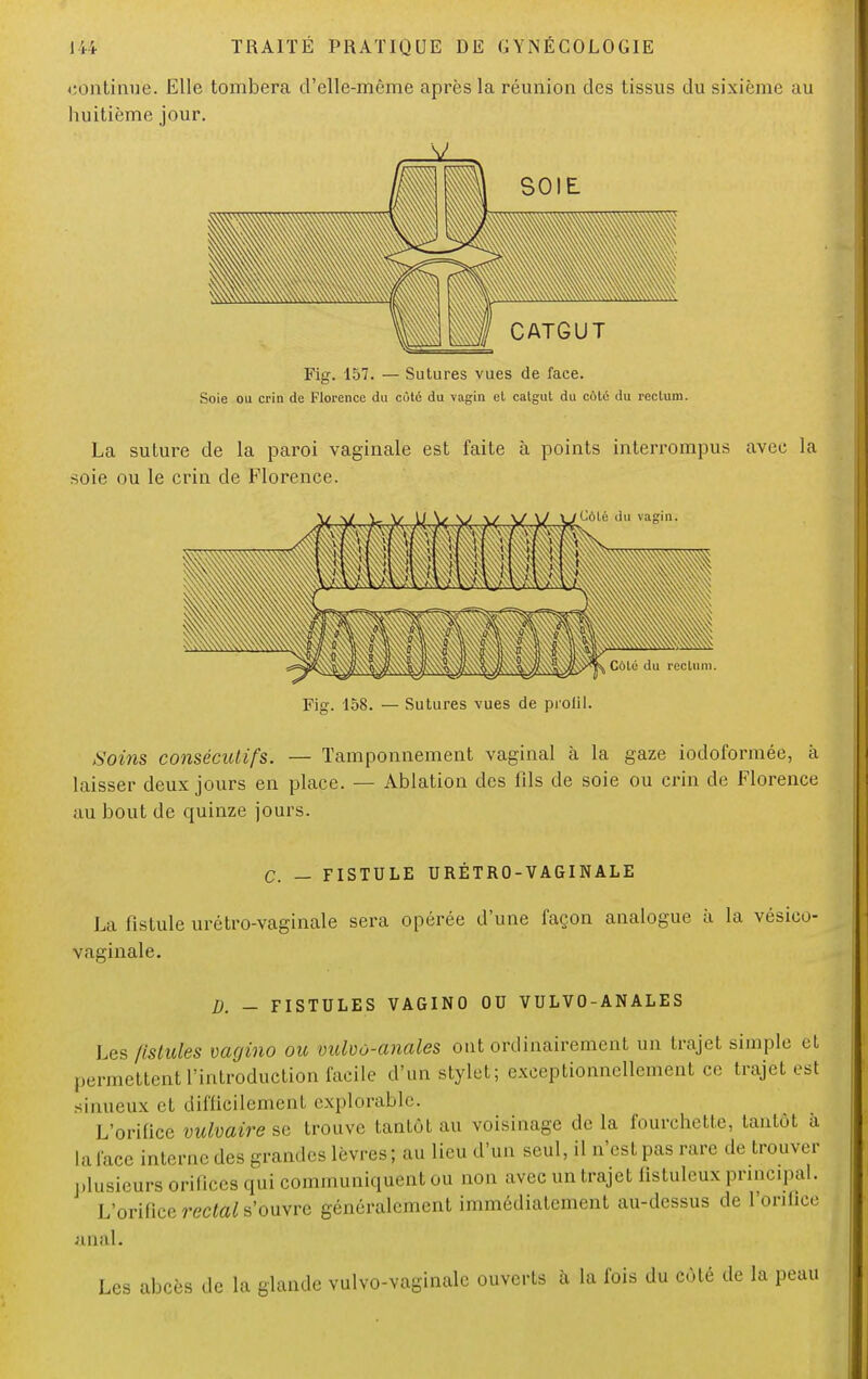 continue. Elle tombera d'elle-même après la réunion des tissus du sixième au huitième jour. SOIE Fig. 157. — Sutures vues de face. Soie ou crin de Florence du cùtc du vagin et catgut du coté du rectum. La suture de la paroi vaginale est faite à points interrompus avec la soie ou le crin de Florence. reclun Fig. 158. — Sutures vues de profil. Soins consécutifs. — Tamponnement vaginal à la gaze iodoformée, à laisser deux jours en place. — Ablation des fils de soie ou crin de Florence au bout de quinze jours. C. — FISTULE URÉTRO-VAGINALE La fistule urétro-vaginale sera opérée d'une façon analogue à la vésico- vaginale. D. - FISTULES VAGINO OU VULVO-ANALES Les fistules vagino ou vulvo-anales ont ordinairement un trajet simple et permettent l'introduction facile d'un stylet; exceptionnellement ce trajet est sinueux et difficilement explorable. L'orifice vulvaire se trouve tantôt au voisinage de la fourchette, tantôt à laface interne des grandes lèvres; au lieu d'un seul, il n'est pas rare de trouver plusieurs orifices qui communiquent ou non avec un trajet fistuleux principal. L'orifice rectal s'ouvre généralement immédiatement au-dessus de l'orifice anal- Les abcès de la glande vulvo-vaginale ouverts à la fois du côté de la peau