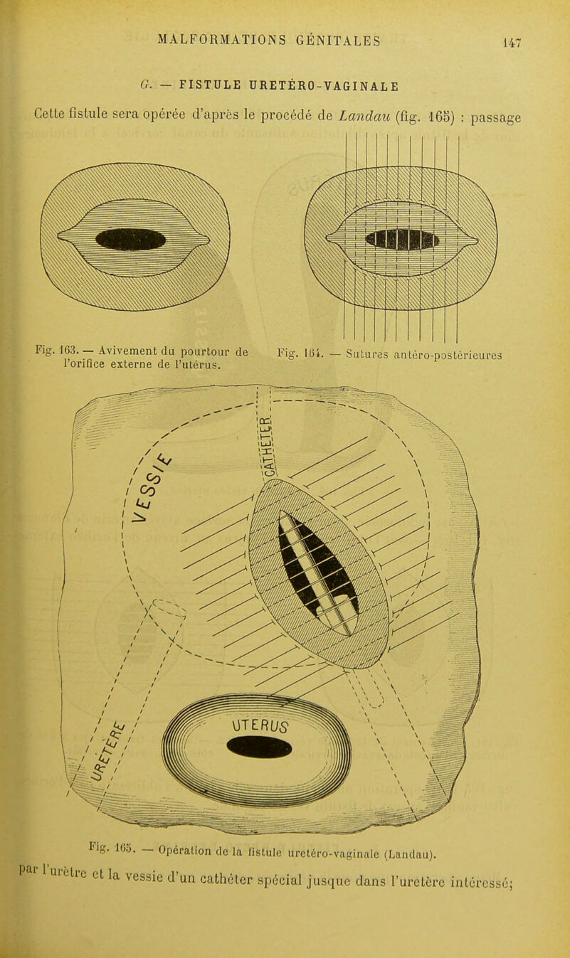 G. — FISTULE URETÉRO-VAGIN AL E Cette fistule sera opérée d'après le procédé de Landau (fig. 165) : passage Fig. 163. - Avivement du pourtour de Fig. 161. - Sutures antéro-postérieures l'orifice externe de l'utérus. Fig. 165. — Opération de la fistule urctéro-vaginale (Landau). Pai 1 urètre et la vessie d'un cathéter spécial jusque dans l'uretère intéressé;