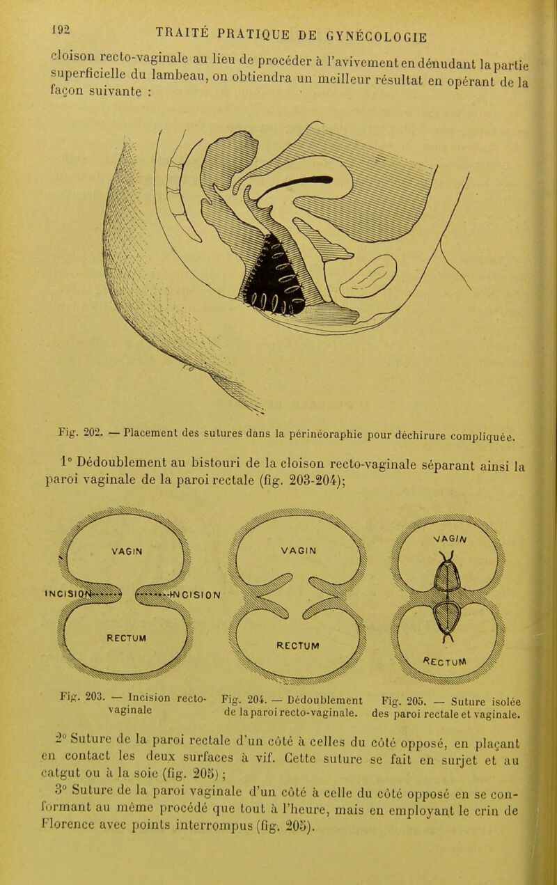 cloison recto-vaginale au lieu de procéder à l'avivement en dénudant laparlie superficielle du lambeau, on obtiendra un meilleur résultat en opérant de la façon suivante : Fig. 202. — Placement des sutures dans la périnéoraphie pour déchirure compliquée. 1° Dédoublement au bistouri de la cloison recto-vaginale séparant ainsi la paroi vaginale de la paroi rectale (fig. 203-204); ig. 203. — Incision recto- Fig. 204. — Dédoublement Fig. 205. — Suture isolée vaginale de la paroi recto-vaginale, des paroi rectale et vaginale. 2° Suture de la paroi rectale d'un côté à celles du côté opposé, en plaçant en contact les deux surfaces à vif. Cette suture se fait en surjet et au catgut ou à la soie (fig. 205) ; 3° Suture de la paroi vaginale d'un côté à celle du côté opposé en se con- formant au même procédé que tout à l'heure, mais en employant le crin de Florence avec points interrompus (fig. 205).