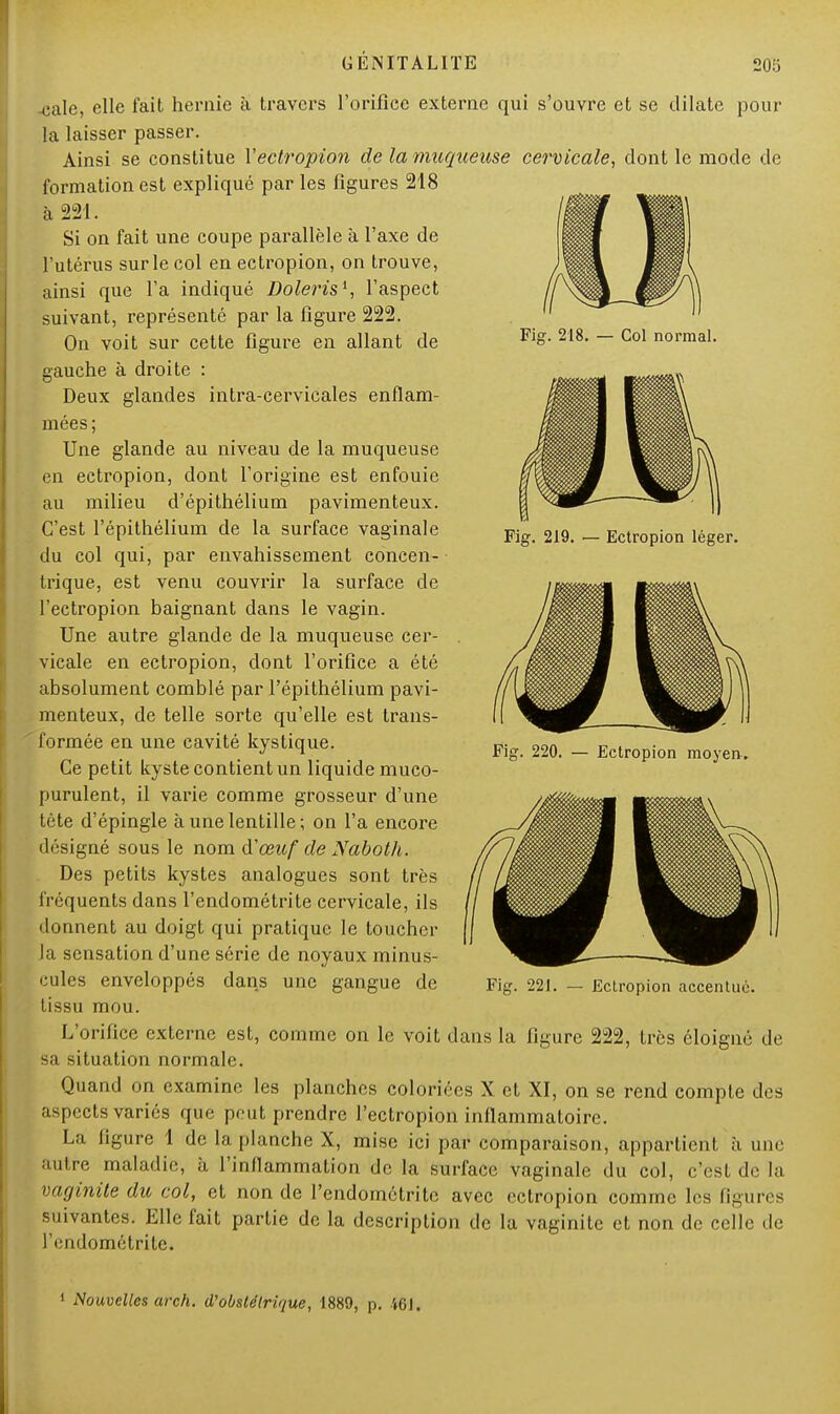 Fig. 218. — Col normal. Fig. 219. — Ectropion léger. -cale, elle fait hernie à travers l'orifice externe qui s'ouvre et se dilate pour la laisser passer. Ainsi se constitue Xectropion de la muqueuse cervicale, dont le mode de formation est expliqué par les figures 218 à 221. Si on fait une coupe parallèle à l'axe de l'utérus sur le col en ectropion, on trouve, ainsi que l'a indiqué Doleris1, l'aspect suivant, représenté par la figure 222. On voit sur cette figure en allant de gauche à droite : Deux glandes intra-cervicales enflam- mées; Une glande au niveau de la muqueuse en ectropion, dont l'origine est enfouie au milieu d'épithélium pavimenteux. C'est l'épithélium de la surface vaginale du col qui, par envahissement concen- trique, est venu couvrir la surface de l'ectropion baignant dans le vagin. Une autre glande de la muqueuse cer- vicale en ectropion, dont l'orifice a été absolument comblé par l'épithélium pavi- menteux, de telle sorte qu'elle est trans- formée en une cavité kystique. Ce petit kyste contient un liquide muco- purulent, il varie comme grosseur d'une tète d'épingle à une lentille ; on l'a encore désigné sous le nom iïœuf de Naboth. Des petits kystes analogues sont très fréquents dans l'endométrite cervicale, ils donnent au doigt qui pratique le toucher la sensation d'une série de noyaux minus- cules enveloppés dans une gangue de tissu mou. L'orifice externe est, comme on le voit dans la figure sa situation normale. Quand on examine les planches coloriées X et XI, on se rend compte des aspects variés que peut prendre l'ectropion inflammatoire. La ligure 1 de la planche X, mise ici par comparaison, appartient à une autre maladie, à l'inflammation de la surface vaginale du col, c'est de la vaginite du col, et non de l'endométrite, avec ectropion comme les figures suivantes. Elle fait partie de la description de la vaginite et non de celle de l'endométrite. Fig. 220. Ectropion moyen. Fig. 221. — Ectropion accentué. !, très éloigné de 1 Nouvelles arch. d'obslétrique, 1889, p. 461.
