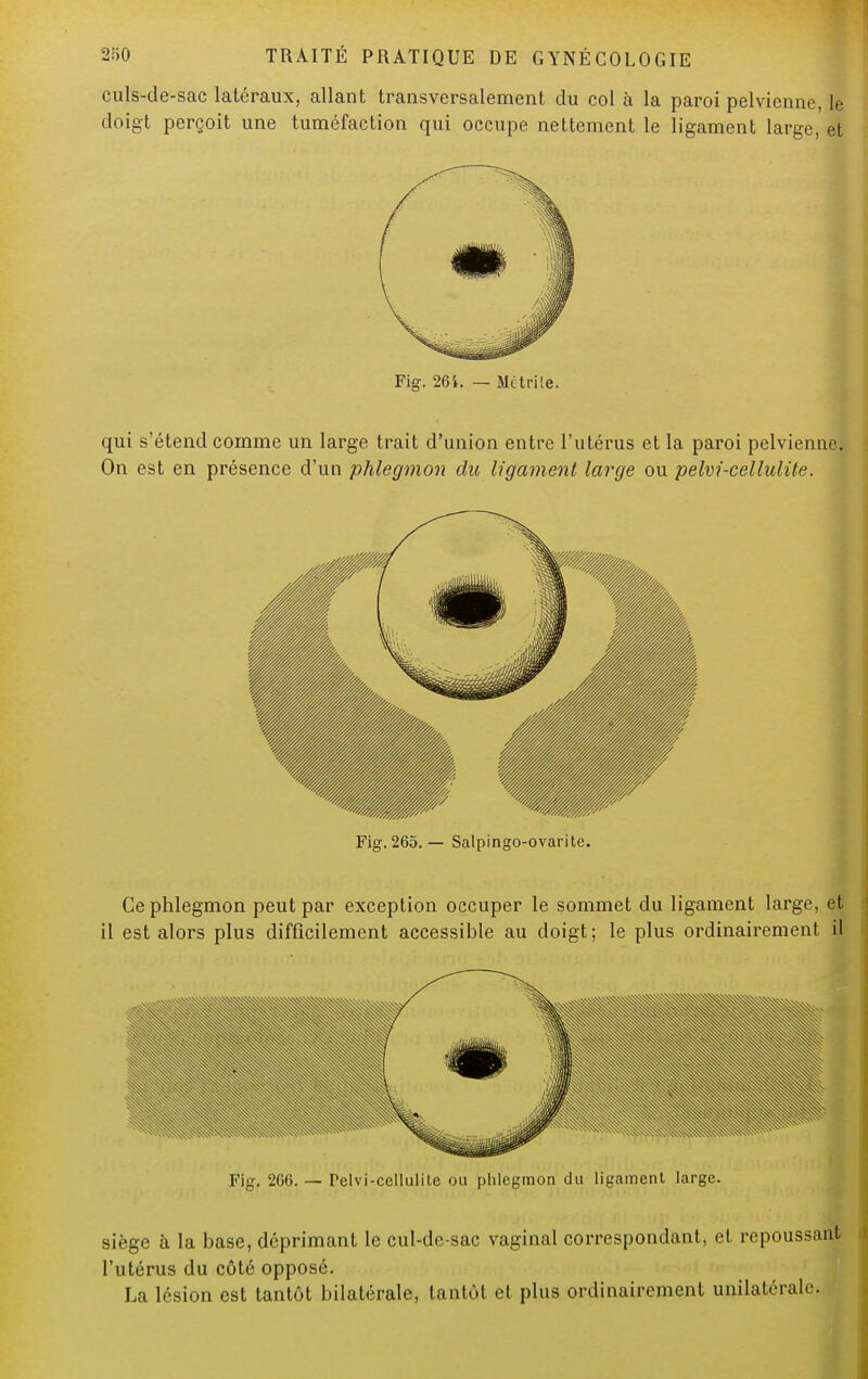 culs-de-sac latéraux, allant transversalement du col à la paroi pelvienne, le doigt perçoit une tuméfaction qui occupe nettement le ligament large, et Fig. 261. — Métrile. qui s'étend comme un large trait d'union entre l'utérus et la paroi pelvienne. On est en présence d'un phlegmon du ligament large ou pelvi-cellulite. Fig. 265.— Salpingo-ovarite. Ce phlegmon peut par exception occuper le sommet du ligament large, et il est alors plus difficilement accessible au doigt; le plus ordinairement il Fig. 266. — Pelvi-celluliLe ou phlegmon du ligament large. siège à la base, déprimant le cul-de-sac vaginal correspondant, et repoussant l'utérus du côté opposé. La lésion est tantôt bilatérale, tantôt et plus ordinairement unilatérale.