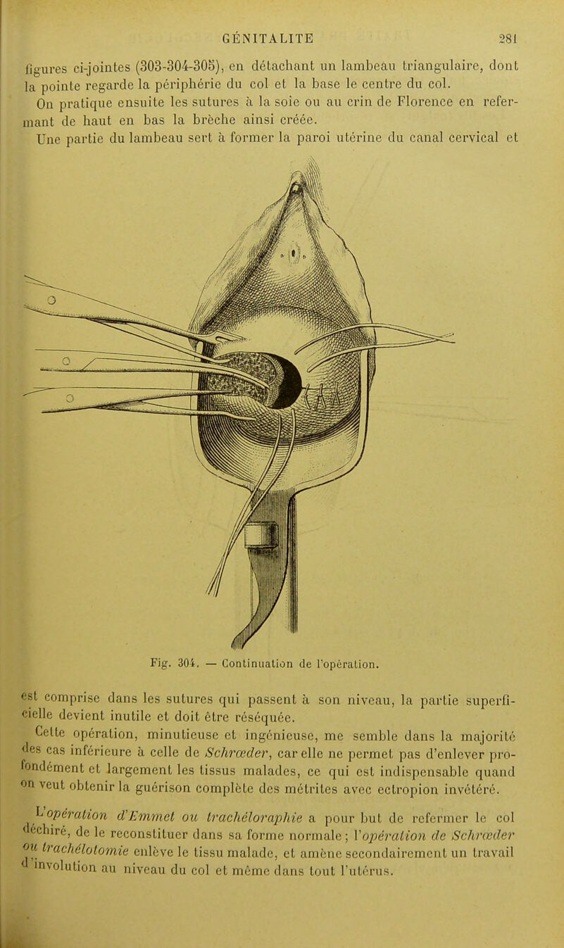 figures ci-jointes (303-304-305), en détachant un lambeau triangulaire, dont la pointe regarde la périphérie du col et la base le centre du col. On pratique ensuite les sutures à la soie ou au crin de Florence en refer- mant de haut en bas la brèche ainsi créée. Une partie du lambeau sert à former la paroi utérine du canal cervical et Fig. 304. — Continuation de l'opération. - 3l comprise dans les sutures qui passent à son niveau, la partie superfi- cielle devient inutile et doit être réséquée. Celte opération, minutieuse cl ingénieuse, me semble dans la majorité «es cas inférieure à celle de Schrœder, car elle ne permet pas d'enlever pro- fondément et largement les tissus malades, ce qui est indispensable quand on veut obtenir la guérison complète des métrites avec ectropion invétéré. L'opération (Ï/Jmmcl ou Irachéloraphie a pour but de refermer le col ' echiré, de le reconstituer dans sa forme normale; Vopération de Schrœder ou Irachélolomie enlève le tissu malade, et amène secondairement un travail d involulion au niveau du col et môme dans tout l'utérus. I